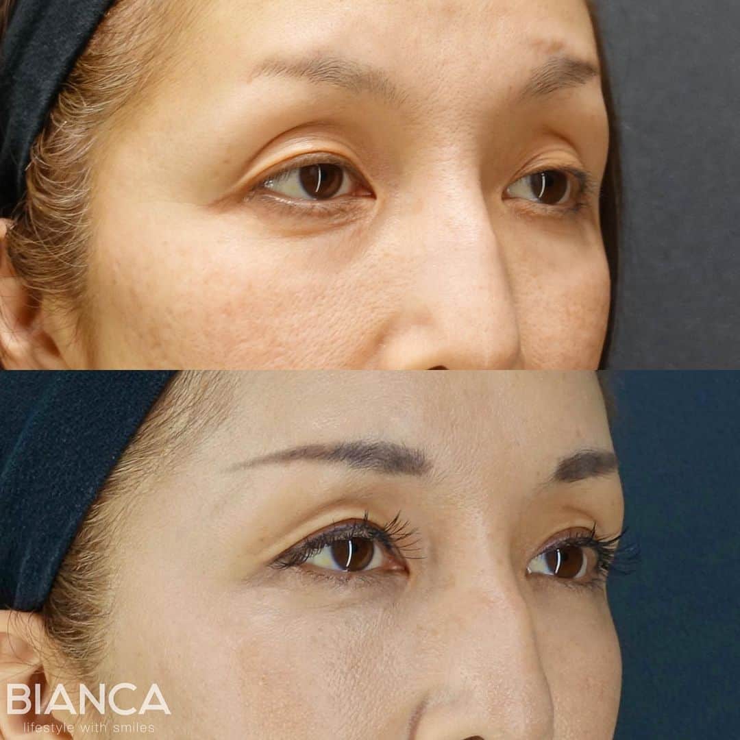 辻沢由有（BIANCA CLNIC 表参道院 院長）さんのインスタグラム写真 - (辻沢由有（BIANCA CLNIC 表参道院 院長）Instagram)「#dryuu目　#dryuu二重  ▶︎swipeで文字なし&別角度症例写真▶︎  窪み目と目の開きの悪さ。 根本解決は切開法ですが、なかなか踏み出せない方は埋没のMT法でもある程度の改善が見込めます😊  今後残った目の上のくぼみに、ヒアルロン酸も少量入れると更に綺麗になりそうなのでご提案もしています😊  上　術前 下　術後1か月  MT法は、特殊な極細⽷でまぶたの裏側の筋⾁を縫い縮めることで⽬の開きを良くする⼿術です。  🌸瞼の開きが悪く⿊⽬が隠れる 🌸眠そうに⾒える 🌸⽬つきが悪いと⾔われる  💉眼瞼下垂（MT法） 💴税込365,580円 😷腫れ 内出血:数日〜1週間程度  *⑅୨୧ ----------------------- ୨୧⑅*  お肌•注入•お手術まで全て担当できます🥰 「何をして良いかわからない」 「ガッツリ変わりたい」「自然な変化が良い」etc...なんでもご相談ください✨  📝ご予約はwebが便利です✨ プロフィール欄のリンクからご予約ください。 ※医師指名可能（“大久保医師指名”をクリック） ※診察料はかかりません🙅‍♀️ ※表参道院勤務が9割となっています。  📍BIANCA CLINIC ※お電話頂くと自動音声通話に繋がります。 ✔︎表参道院 ☎️05018071593 東京都港区南青山5-11-10  南青山511ビル 2F ✔︎銀座院 ☎️05031964834 東京都中央区銀座1-8-19 キラリトギンザ12F  •診療時間 10:00〜19:00 •年中無休（年末年始を除く）   #二重切開 #二重埋没 #二重整形 #埋没法#二重埋没法 #タッキング #切らない眼瞼下垂症手術 #切らない眼瞼下垂 #MT法 #眼瞼下垂手術 #眼瞼下垂 #くぼみ目 #くぼみ目改善」7月23日 13時57分 - i_am_yuu__