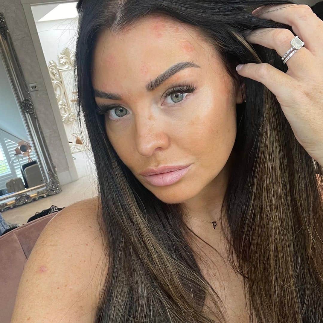 Jessica Wrightのインスタグラム：「Here goes…. Psoriasis update.   Apologies for my absence on discussing my ongoing battle with psoriasis, however here it is. In November I went to a specialist & I was put on a form of medication in the hope that it would stop it in its tracks, calm it down & then when I come off of the meds after around a year, it wouldn’t be as aggressive. This medication cleared nearly all of my psoriasis which was wonderful for a little while… however side effects of the meds started to creep in & become more evident which didn’t make me feel great & then when I tried lowering the dose, the psoriasis started to come back with a vengeance. It’s actually I’d say on par with how it was before, if not worse. And it’s actually really sore. So frustrating. I’m posting this because so many of you have messaged me asking how it’s going & I’ve not been updating you so here it is. Sorry I don’t have any better news & a miracle cure for you all, I feel your frustration guys. Repeat after me ‘F*** you psoriasis 🖕🏽’」