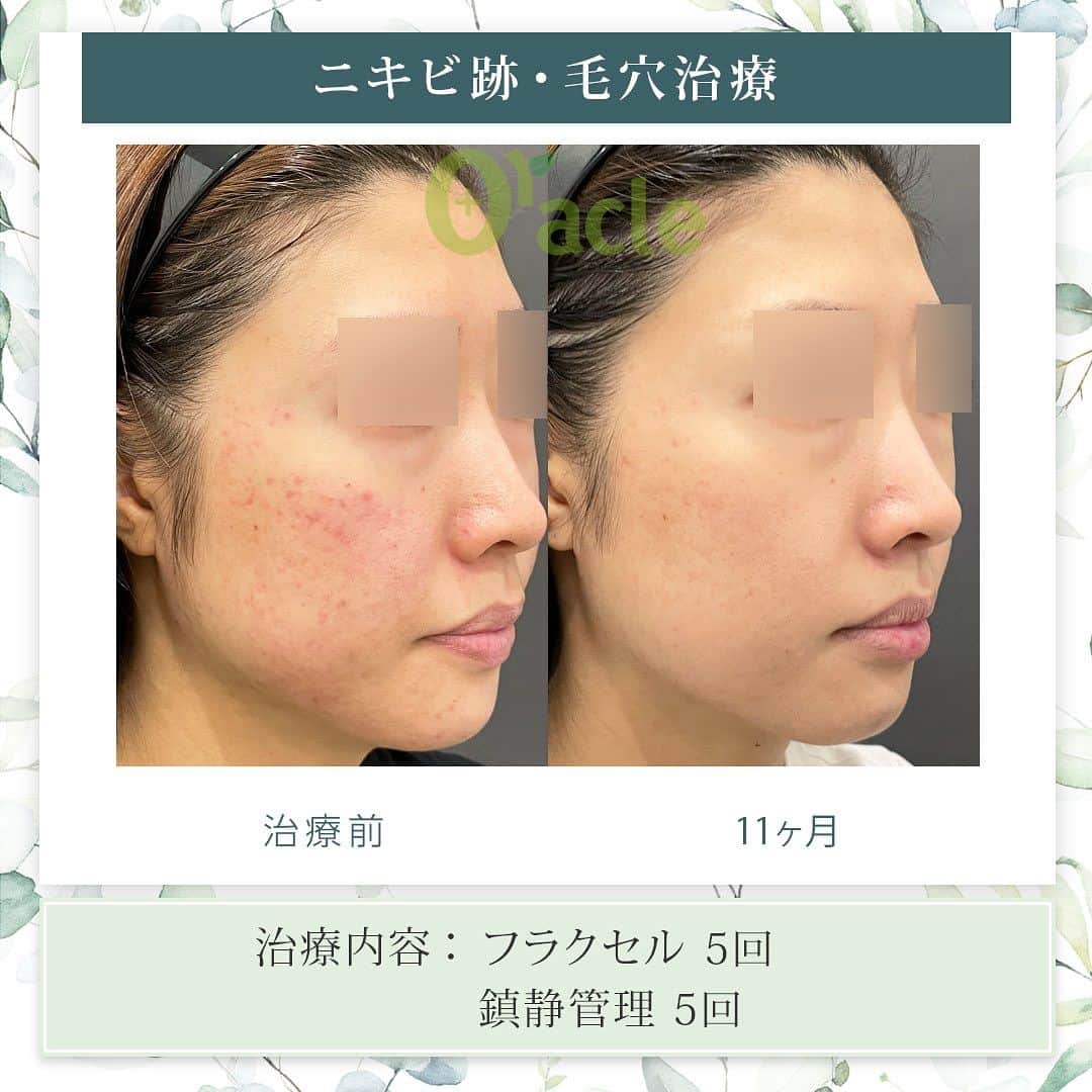 オラクル美容皮膚科東京新宿院さんのインスタグラム写真 - (オラクル美容皮膚科東京新宿院Instagram)「|◤ニキビ跡、毛穴の治療症例◢|  《治療内容》 フラクセル5回 鎮静管理5回 ☞約一年後も美肌をキープ。  ☑️フラクセル 1回の治療でお肌の5〜15%を入れ替えるレーザー治療  【ダウンタイム】 赤み：2〜10日 浮腫み：出る方もいる 皮剥け：5〜7日 洗顔、メイクは翌日以降 ⁡ 【料金】※税込み ▶︎フラクセル1回19,800円 麻酔代2,200円  ▶︎鎮静管理　1回11,000円 フラクセル後はお肌に熱がこもった状態になります。マイナス15度で冷やしながら鎮静保湿成分を導入する韓国式の治療です。 ⁡ #ニキビ跡 #ニキビ跡治療 #フラクショナルレーザー #ニキビ皮膚科 #皮膚科 #美肌 #毛穴 #毛穴引き締め #毛穴ケア #フラクセル #フラクショナル #レーザー治療」7月24日 17時35分 - oraclejp