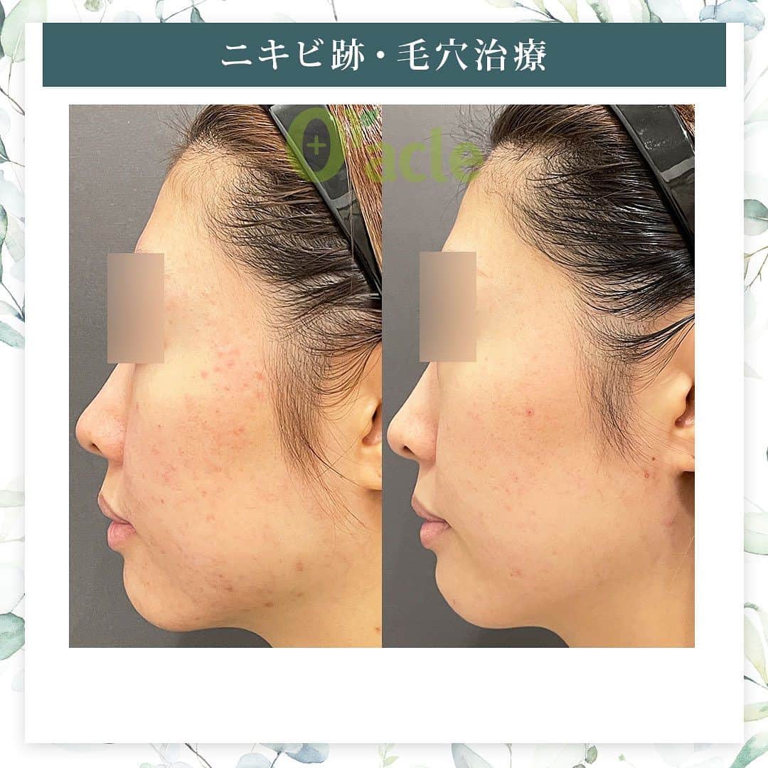 オラクル美容皮膚科東京新宿院さんのインスタグラム写真 - (オラクル美容皮膚科東京新宿院Instagram)「|◤ニキビ跡、毛穴の治療症例◢|  《治療内容》 フラクセル5回 鎮静管理5回 ☞約一年後も美肌をキープ。  ☑️フラクセル 1回の治療でお肌の5〜15%を入れ替えるレーザー治療  【ダウンタイム】 赤み：2〜10日 浮腫み：出る方もいる 皮剥け：5〜7日 洗顔、メイクは翌日以降 ⁡ 【料金】※税込み ▶︎フラクセル1回19,800円 麻酔代2,200円  ▶︎鎮静管理　1回11,000円 フラクセル後はお肌に熱がこもった状態になります。マイナス15度で冷やしながら鎮静保湿成分を導入する韓国式の治療です。 ⁡ #ニキビ跡 #ニキビ跡治療 #フラクショナルレーザー #ニキビ皮膚科 #皮膚科 #美肌 #毛穴 #毛穴引き締め #毛穴ケア #フラクセル #フラクショナル #レーザー治療」7月24日 17時35分 - oraclejp