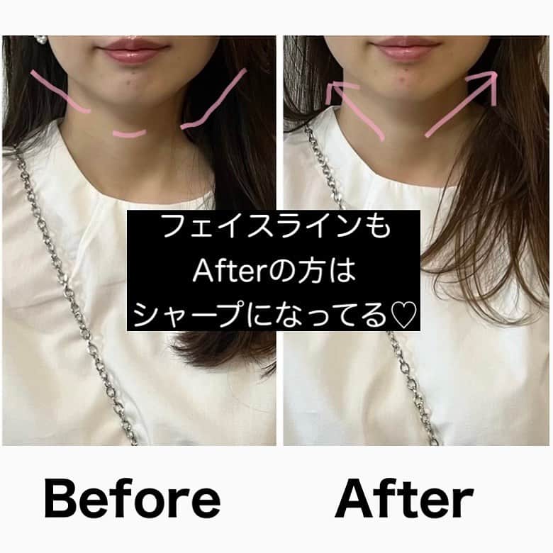 kaorinさんのインスタグラム写真 - (kaorinInstagram)「先日初体験したハイフ、 目周りがスッキリしたり、 フェイスラインがシュッとしたりと 自分なりに効果を感じたので 2回目のハイフに行ってきました🤍  東海地区初の看護師ハイフ専門サロン @medicalace_nurse で 受けてきましたよ🥰  今回も目周りのたるみがスッキリしたし、 フェイスラインもすごくシュッとしました✨  ビフォアフ載せてるので スワイプして見てみて下さいね♡  顎下のもたつきが Afterだとスッキリしてます♡  今回も痛みは全然我慢できるくらいでした✨  なにより2回目なので 今回はそんなに緊張しなかったし、 サロンのオーナーさんは 美容皮膚科専門看護師さんで 施術人数も一万人以上の実績がある方なので、 今回も安心してお任せできました♡  そして相変わらず美肌すぎて、 オーナーさんが愛用してる 炭酸パックを教えてもらって 私も買いました♡笑  名古屋の伏見駅から徒歩5分で プライベートサロンだから子連れもOKだそうです🤍  お値段も、美容皮膚科の1/4の価格で お値打ちなので、 ハイフ気になってた方、 ぜひチェックしてみて下さいね🥺💘  #medicalace#medicalace_nurse#プライベートサロン#メディカルエース#メディカルエース名古屋#ハイフ#ハイフエステ#美容#アラフォー#アラフォー美容#美容好き#水光ピーリング」7月26日 23時05分 - kaorinnnhyrk