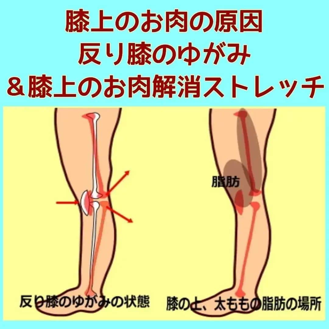 中目黒整体レメディオ 院長　渡邉潤一さんのインスタグラム写真 - (中目黒整体レメディオ 院長　渡邉潤一Instagram)「膝の上にお肉が付いてしまうのは、整体的には下記に挙げる３つのプロセスで起こると考えられます。  １：膝のゆがみである反り膝により、太ももの骨の位置、さらに膝下の骨がゆがみます。それにより膝関節に詰まりが生じる  ２：太もも前側にある筋肉（大腿四頭筋）が緊張した事で、膝部分の皮膚との間にも隙間が生まれる  ３：その隙間に、むくみが溜まり、さらにむくみが脂肪を引き寄せふくらむ  膝の上にお肉がついている方は、腰が反っていて（反り腰）、骨盤が前側に傾いています（反り腰の骨盤）。 さらに膝関節が後ろへと弓なりにゆがんでいます（反り膝）  骨盤のゆがみから膝関節が弓なりにゆがみ、太ももの筋肉を緊張させたことで、膝の皮膚との間に隙間が生まれます。いわゆる、たるみですね。  また、筋肉が硬くなり弱くなったことで、皮膚を引き寄せられない状態なり、その皮膚がたるんだ部分にむくみが入り込む事でたるみを大きくふくらませます。  これが骨のゆがみにより、膝の上にお肉がついてしまう原因です。 . . . ーーーーーーーーーーーーーーーーーーーーー  💮施術のご案内💮 中目黒整体レメディオ：骨盤・美脚コース 施術をご希望の方は、HPの予約フォームか、 お電話（0357735977）にてご連絡ください。  ーーーーーーーーーーーーーーーーーーーーー . . . #大転子 #大転子矯正 #o脚矯正 #x脚矯正 #膝下o脚 #XO脚 #骨格矯正 #骨盤矯正 #産後骨盤矯正 #下半身太り #下半身痩せ #反り膝  #反り腰 #骨盤の歪み #整体 #姿勢矯正 #中目黒整体レメディオ #整体サロン #骨格診断 #反り膝ストレッチ」7月27日 15時21分 - remedio_watanabe