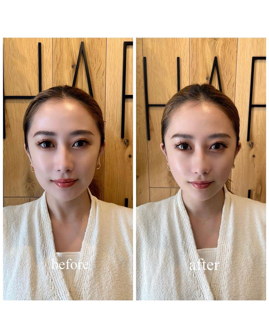 藤井萌さんのインスタグラム写真 - (藤井萌Instagram)「幹細胞フェイスリフトをしてきたよー🤍  東京にあるナチュラルハーモニークリニック @nhc_clinic にいきました！  オリジナルの特別な繊維と 幹細胞上清液を組み合わせた 次世代のフェイスリフト🥹✨  わたしは左右3本づつ、計6本入れてもらいました！ 画像三枚目をご覧下さい💁（ノーマルカメラだよ）  三枚目にのせたビフォーアフターすごくないっ？！ 顔がめっっちゃスッキリして、加工したみたいに シュッとしました🥹🥹🥹 衝撃だからスライドしてみてみて👀笑  初めてのフェイスリフトで怖かったけど スタッフさんがめっちゃ優しくて、 あっという間に終わりました🥹 腫れもなく、術後から顔がめっちゃあがってて ほんとに感動😭💛  コラーゲンの生成促進効果で 肌もツルツルもちもちで大感動🥹  また来年もやりたいなーー🥹🥹 ㅤㅤㅤ  #糸リフト #フェイスリフト #スレッドリフト #幹細胞フェイスリフト  #ナチュラルハーモニークリニック表参道　#NHC #表参道 #美容 #小顔 #リフトアップ #美容外科 #美容皮膚科 #美容クリニック #幹細胞上清液　#再生医療」7月27日 20時59分 - fujii_moe