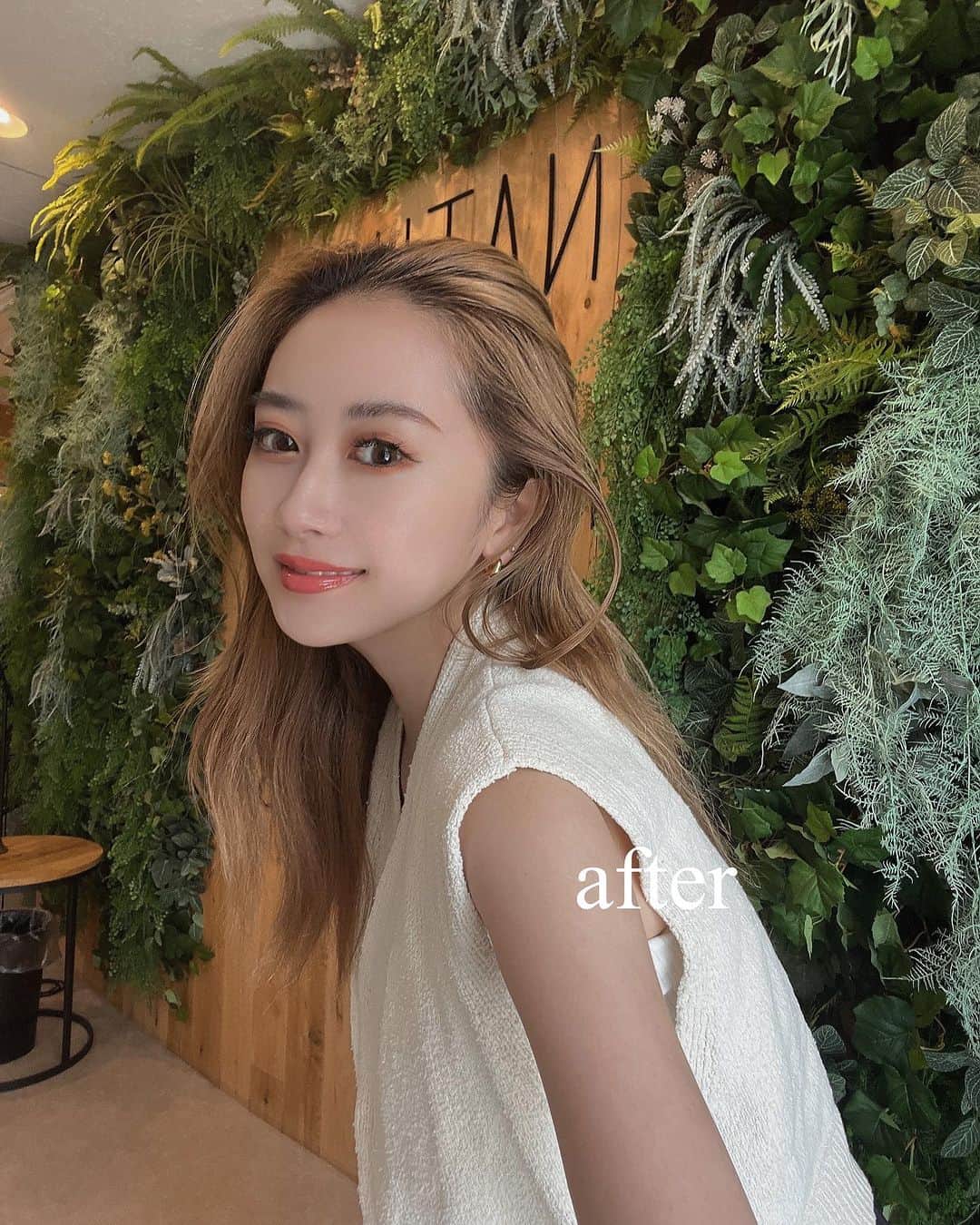 藤井萌さんのインスタグラム写真 - (藤井萌Instagram)「幹細胞フェイスリフトをしてきたよー🤍  東京にあるナチュラルハーモニークリニック @nhc_clinic にいきました！  オリジナルの特別な繊維と 幹細胞上清液を組み合わせた 次世代のフェイスリフト🥹✨  わたしは左右3本づつ、計6本入れてもらいました！ 画像三枚目をご覧下さい💁（ノーマルカメラだよ）  三枚目にのせたビフォーアフターすごくないっ？！ 顔がめっっちゃスッキリして、加工したみたいに シュッとしました🥹🥹🥹 衝撃だからスライドしてみてみて👀笑  初めてのフェイスリフトで怖かったけど スタッフさんがめっちゃ優しくて、 あっという間に終わりました🥹 腫れもなく、術後から顔がめっちゃあがってて ほんとに感動😭💛  コラーゲンの生成促進効果で 肌もツルツルもちもちで大感動🥹  また来年もやりたいなーー🥹🥹 ㅤㅤㅤ  #糸リフト #フェイスリフト #スレッドリフト #幹細胞フェイスリフト  #ナチュラルハーモニークリニック表参道　#NHC #表参道 #美容 #小顔 #リフトアップ #美容外科 #美容皮膚科 #美容クリニック #幹細胞上清液　#再生医療」7月27日 20時59分 - fujii_moe