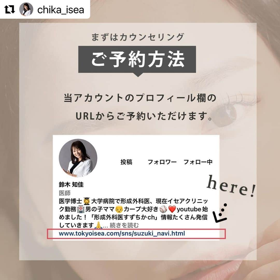 東京イセアクリニックさんのインスタグラム写真 - (東京イセアクリニックInstagram)「▶︎▷▶︎ 埋没法プレミアム  ▼執刀医 Dr.鈴木 知佳　@chika_isea   ▼詳細 【施術の詳細】 🕐手術時間 ・・・約10分 👁ダウンタイム・・・約1週間 📆完成まで ・・・約1か月 🏥術後の通院　・・・不要 . 【埋没法プレミアムとは？】 通常の３点留めとは違い、３点目の糸を２点の糸に絡めて固定することにより、 当院の埋没法の中で一番取れにくく、切開法のようなクッキリとしたラインにすることができます。 . 【こんな方におすすめです！】 ✔️まぶたが厚く、埋没法が不安に思う方 ✔️埋没法が取れてしまった経験がある ✔️切開法のようなくっきりとしたラインになりたい . 【埋没法の保証について】 1️⃣デザイン変更 完成後1ヶ月以内であれば、二重幅変更の再手術が可能です。 . 2️⃣取れた際の再手術 万が一糸が取れてしまった場合でも、5年間無料で再手術が可能です。 . 【リスクについて】 血腫・感染の可能性がある、腫れ、内出血、鈍痛 . . --------------------------- . ▫️術名 埋没法プレミアム . ▪️料金 両目　198,000円(税込)  (麻酔費・痛み止め費・二重幅変更費・再施術費込み)  --------------------------- . . . Before・・・術前 After ・・・1か月後 . =========================== .  ご予約・お問い合わせは、  プロフィール欄の URLからお願いします！😊  . =========================== . . ⏩埋没法だけの 症例写真やお役立ちコンテンツを毎日更新！ . 『　@maibotsu_isea　』 是非チェックしてみてください😊 . . #埋没法プレミアム #イセアの埋没法 #埋没法 #二重埋没法 #二重整形 #美容外科医 #美容外科 #美容クリニック #美容整形 #二重まぶた #二重 #二重になりたい #アイプチ #アイテープ #切開法 #二重埋没法経過 #埋没法3点 #埋没法2点 #デカ目 #プチ整形 #東京イセアクリニック #イセア #ISEACLINIC #吉種克之 #鈴木知佳」7月28日 11時01分 - iseaclinic