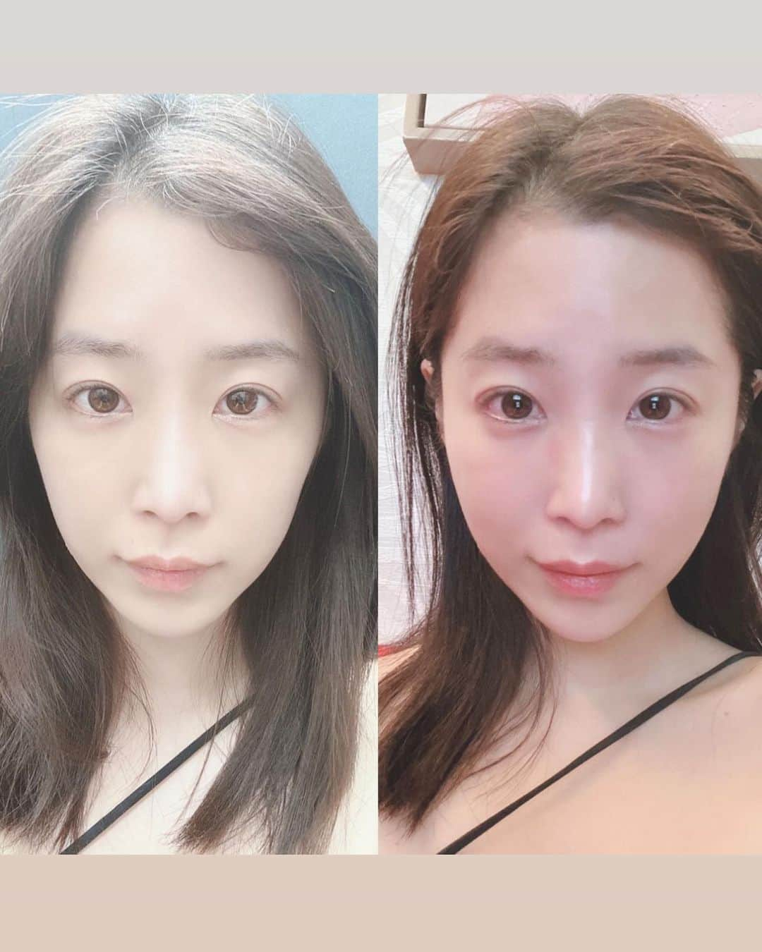 休井美郷さんのインスタグラム写真 - (休井美郷Instagram)「「レーザートーニングと、糸リフトは、40歳になった時に絶対感謝するからこれだけはやっとけ。」   ってずっとみてもらってる先生に言われ続け、やっと決心。   すごすぎるんだけど。   私もともと頬にお肉があまり付かなくて、面長で痩けて老けて見えるから、スッキリというかもはやふっくらさせたいって言ってて…… そんなことが叶うのかと思ったら、、まぁすごい。   口のもたつきはめちゃくちゃスッキリして、頬はふっくらしている😭‪🫶🏻‎🤍   感動。   しかも青柳先生ナチュラル思考だから、違和感なくてめちゃくちゃ自然🥺♡（先生と顔の好みが似てるとかってすごい大切だと思ってる）   悩みが解消された、嬉しすぎる🥺   で、私このままお仕事で大阪で、めちゃくちゃ内出血にドキドキしてたんだけど、内出血に効くクリームとドリンクも頂いてとっても安心😌   やってよかったー！！というかもっとさっさとやっておけば良かった。笑   結論、年齢と重力には勝てへんのよ。  アンチエイジング頑張るぞ。#アラサー   @sbc_futakotamagawa @sbc_moeka_aoyagi #湘南美容クリニック#湘南美容クリニック二子玉川院#美容クリニック#青柳萌花#糸リフト#フェイスライン#小顔#たるみ改善」7月28日 20時02分 - kyuui_misato