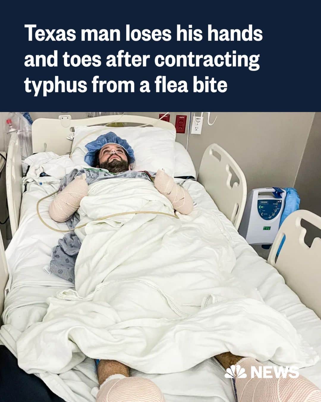 NBC Newsさんのインスタグラム写真 - (NBC NewsInstagram)「A Texas man has lost his hands and parts of his feet after contracting a severe case of typhus from a flea bite.  Typhus is an infectious disease caused by bacteria that can spread from flea, lice and chiggers.   Michael Kohlhof, 35, began to show flu-like symptoms, including a fever and upset stomach, last month, according to his brother, Greg Kohlhof. A week after the symptoms set in, Michael’s condition worsened rapidly.  Greg said his brother has been staying optimistic.   “His spirits are something to be admired,” his brother Greg said. “He seems to try to keep a positive attitude, keeping himself distracted — I think he’s grabbed onto the notion that he survived death.”  Though typhus is rare in the U.S., it has been found in Southern California, Hawaii and Texas, according to the CDC.   Read more at the link in bio.」7月29日 5時33分 - nbcnews