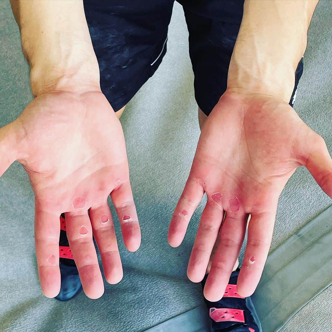 アレックス・ブノワのインスタグラム：「First V4 only took 9 blisters 👍👍 #GotSomeBlisties」