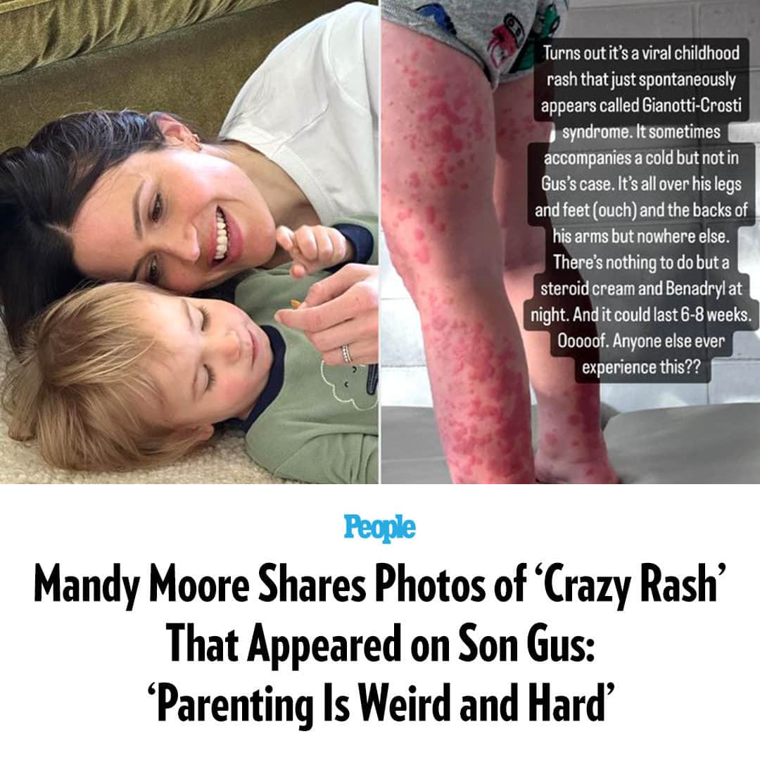 People Magazineさんのインスタグラム写真 - (People MagazineInstagram)「Mandy Moore has had some serious adventures in parenting this week. On Friday, the 'This Is Us' alum shared the story of a "crazy rash" she discovered on her 2-year-old son August “Gus” Harrison.  Tap our bio link for the full story. | 📷: Instagram」7月30日 1時15分 - people