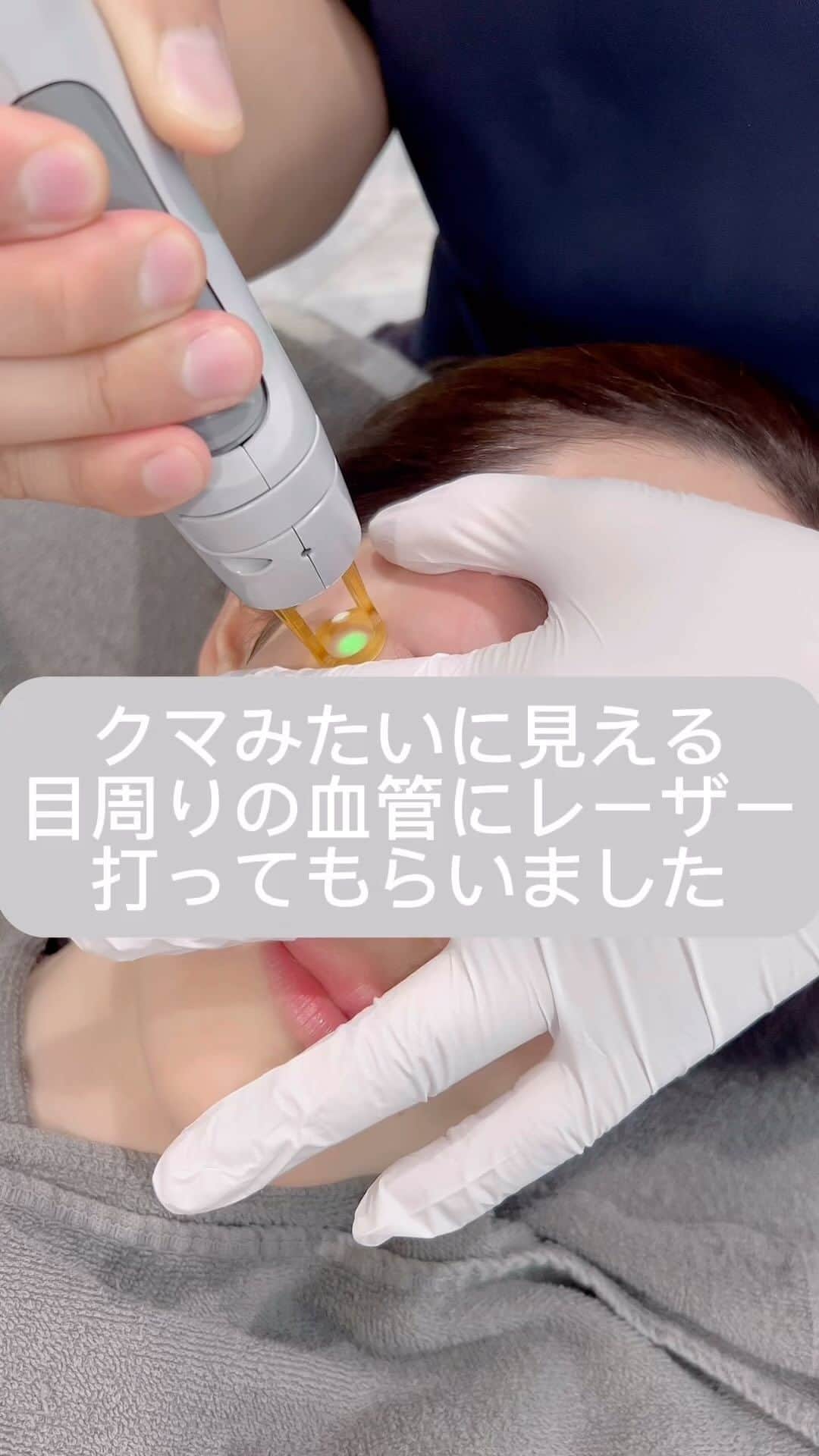 のインスタグラム：「去年の11月、ビョン先生に ヒアルロン酸やってもらった時に 目周りの青い血管レーザーで消せますよ〜って 教えてもらい。え？！そうなんですか？ やります！！！って言ってなかなか行けず、 先月ついにやってもらいました🏃🏻‍♀️🏃🏻‍♀️  ジェントルマックスプロってやつです。 このレーザーは基本は脱毛の機械なのでビョン先生オリジナルの使い方らしいです🙋🏻‍♀️  私は特に左の血管がちょうどクマの線のように入ってて メイクしても完璧には隠れず地味にずーーっと 気になってたのでやってよかった‥！！！  このレーザーは一回やったらそれでもう一生 血管が出てこないわけじゃなく、 また出てきたらやる必要はあるそうです。  でも1ヶ月経って今の所元に戻ってはないから また出てきたらお願いしようと思ってますᐠ(  ᐢ ᵕ ᐢ )ᐟ  動画撮ってくれた @momoko.kawakami.29 さん 付き添ってくださってありがとうございました🩷 桃さんから、ダウンタイムは2〜3日腫れるかも？ くりにた内出血ももしかしたら出るかも？と言われてたけど 何もなく次の日からメイクもできました。  どうやら肌色が明るいと血管だけに反応するから 腫れにくいんだそう。  あと同じ日にヒアルロン酸のメンテと、 いつぶりか忘れたぐらい 久しぶりのエラボトもしてもらいました。  ヒアルロン酸は1週間くらいすると 腫れ感も落ち着いて馴染みます。 ボトックスも1週間くらいで効果は出てくるかな大体。  注入もビョン先生です✨ @dr_byon   クリニックは @lekarkaclinic 🏥  レカルカクリニック、ナースさんも皆さん 優しい雰囲気の方ばかりで癒されるから大好き🫶🏻🩷」