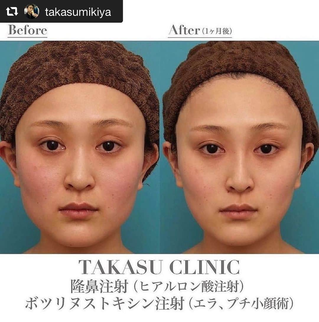 高須クリニック名古屋院のインスタグラム：「#repost @takasumikiya via @PhotoAroundApp  長期持続型ヒアルロン酸注射とボツリヌストキシン注射（エラ、プチ小顔術）を行った症例写真の術前術後画像 ⁡ 20代女性の患者様で、鼻が低いのと、エラが張っているのが悩みで来院されました。 診察させていただいたところ、鼻に関しては、鼻根部がやや低く、鼻筋の通りがやや中途半端でした。 エラに関しては、エラの骨と筋肉（咬筋）が発達して、横に張っていました。 エラが横に張っている要因の比率としては、骨:筋肉＝3:7くらいで、筋肉によるものが大きく占めていました。 鼻に関しては、まずはシリコンプロテーゼではなく、簡単なプチ整形でやってみたいとのことでしたので、鼻専用の長期持続型ヒアルロン酸を注入することになりました。 エラに関しては、エラが張っている原因のほとんどは筋肉によるものなので、エラ削りなどの骨切り手術ではなく、ボツリヌストキシン注射をすることになりました。 長期持続型ヒアルロン酸は、約0.7ccを眉間の下部~鼻根部~鼻背にかけて注入し、ほどよく自然に鼻筋を通しました。 ボツリヌストキシンは、頬が痩けないように、咬筋の下顎角付着部のみに注射し、頬骨弓の付着部周辺には注射しませんでした。 長期持続型ヒアルロン酸は、従来のヒアルロン酸に比べ密度が高く、硬さがあるため、注入したヒアルロン酸が横に広がって鼻が太くなることがなく、自然な高さの綺麗な鼻になりました。 また、発達していたエラの筋肉のボリュームが萎縮し、フェイスラインがシャープな小顔になりました。 ⁡ 【料金】 ●隆鼻注射（ヒアルロン酸注射） ヒアルロン酸注射 ¥55,000（税込） 長期持続型ヒアルロン酸注射シャープラインノーズ ¥165,000（税込） 【全院 】 ⁡ ●ボツリヌストキシン注射（エラ、プチ小顔術） 1回 ¥165,000（税込） 【全院 】 ⁡ 【リスク・副作用・合併症】 ●隆鼻注射（ヒアルロン酸注射） 内出血（注射針が血管に当たってしまった場合）  仕上がりのわずかな左右差（完璧なシンメトリーは不可）  仕上がりが完璧に自分の理想の形にならないことがある  アレルギーが生じる可能性  注入後の感染  血流不全、皮膚壊死  過度にいじったり揉んだりすると腫れる可能性 ⁡ ●ボツリヌストキシン注射（エラ、プチ小顔術） 内出血（注射針が血管に当たってしまった場合） 妊活・妊娠・授乳中の方への施術不可 / 仕上がりのわずかな左右差（完璧なシンメトリーは不可） 一時的に噛む力が弱く感じる ⁡ ⁡ 【ご予約・お問い合わせ】 名古屋院☎︎ 052-564-1187 名古屋院📱 @takasuclinic_nagoya ↑名古屋院インスタのプロフィール画面からも直接コンタクトが取れます📲 https://www.takasu.co.jp/ ⁡ ⁡ #高須クリニック #高須クリニック名古屋院 #高須幹弥 #高須英津子 #美容整形 #整形 #二重 #埋没法 #二重切開 #ヒアルロン酸 #鼻 #ニキビ #豊胸 #たるみ #しみ #シワ #ほうれい線 #毛穴 #目 #整形したい #美容好きな人と繋がりたい #可愛くなりたい #綺麗になりたい #平行二重 #末広二重 #プチ整形 #二重整形 #痩せたい  #ビフォーアフター」