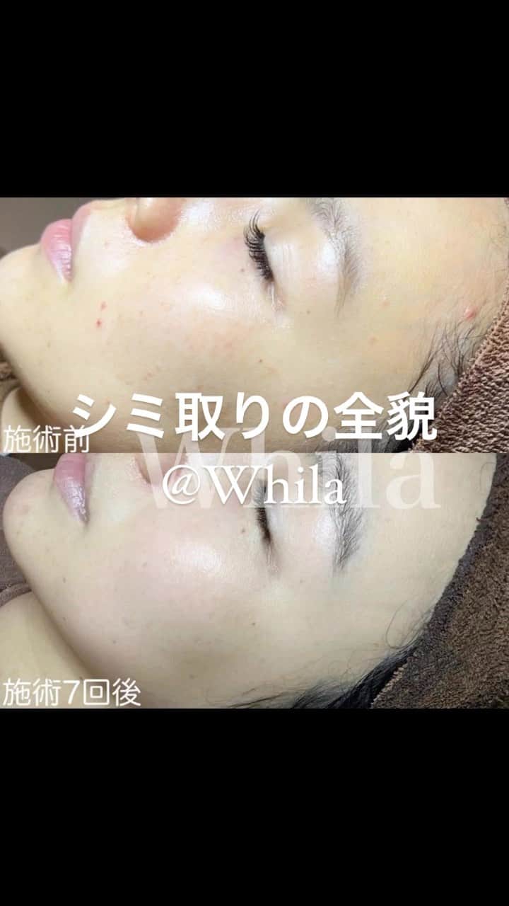 赤松悠実のインスタグラム：「ホワラのシミ取り 全貌😳👏❤️  @whila_my   頑張ってリールとか作ってみた🤣  #シミ取り#大阪#ホワラ#ホワラのシミ取り#美肌#スキンケア #シミ#美容#ママ#男の子ママ」