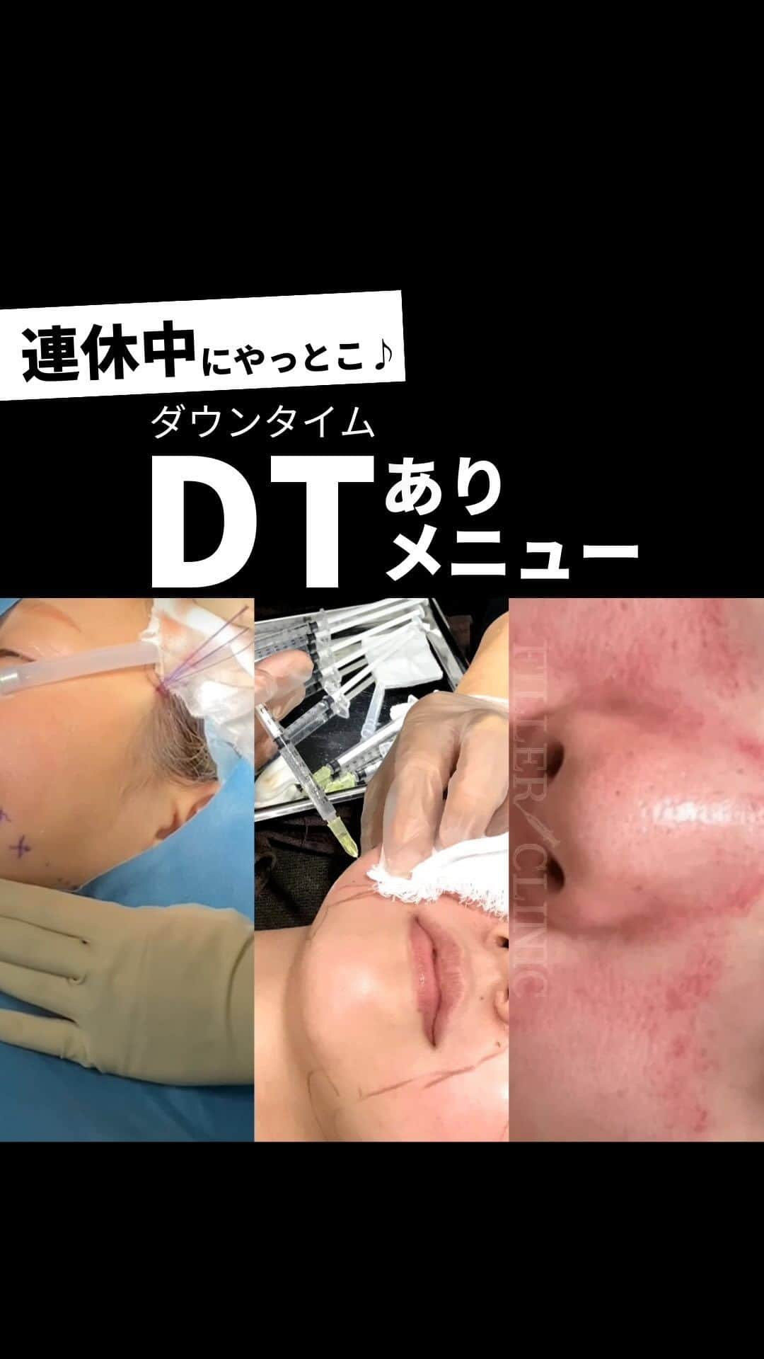 恵比寿フィラークリニックのインスタグラム：「連休中にやっとこ？😎 ダウンタイムありメニュー💉  ✅糸リフト(スレッドリフト) 〇フィラリフト アンカー付きの特殊な糸を挿入し牽引作用によりリフトアップ効果が得られます！ たるんだ頬を引き締め小顔効果抜群のメニューです💖 1年前後で体内に吸収されます。  〇シャークリフト トゲ状のモールディング糸を挿入し、 肌へのダメージを最小限にしながらコラーゲンを生成し、ハリ艶UP、 たるみ改善効果が得られます💕  ✅埋没二重 皮膚の内側に特殊な糸を通し、二重のラインをつくる手法です👀💕  ✅脂肪溶解注射 薬剤を注入し、脂肪細胞自体を分解・溶解し、溶け出した脂肪は汗や尿となって自然に体外に排出されます🤭  ✅ダーマペン4 髪の毛よりも細い超極細針で肌に無数の穴をあけ、自然治癒力を高めます！ ☑毛穴の引き締め ☑ニキビ跡・色素沈着の改善 ☑小じわ・ハリの改善  顔だけじゃなく、二の腕・太腿・おしり・おなか・胸などの身体にも施術可能です✨ 妊娠線や肉割れの改善にGOOD😍  #フィラークリニック #糸リフト #糸リフトダウンタイム #埋没二重 #二重埋没 #二重 #二重瞼 #アイプチ卒業 #アイプチ #ダーマペン #ダーマペン4 #ダーマペン経過 #妊娠線 #妊娠線ケア #肉割れ #肉割れ改善 #美容 #美容男子 #美容好き #美活 #プチ整形 #snowman」