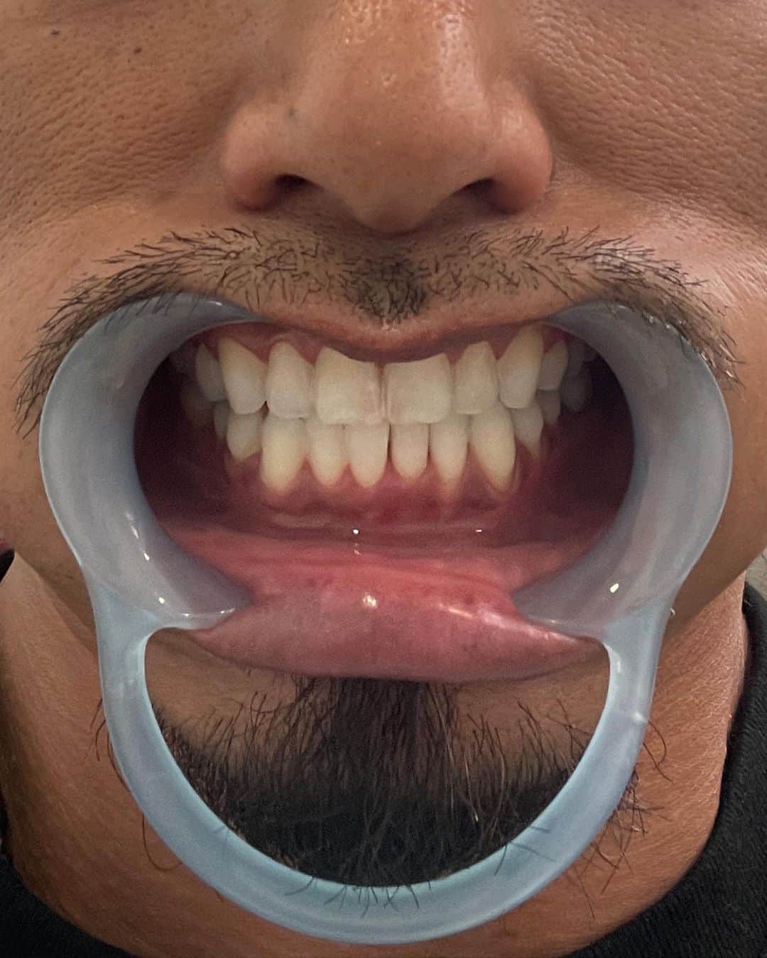 鷹木信悟さんのインスタグラム写真 - (鷹木信悟Instagram)「今日は大阪大会に合わせてウエノ歯科へ🦷 定期的な歯のメンテナンスです✨ ホワイトニングで白くなり、マウスピース矯正で歯並びもかなり改善しました！ 治療もして頂き、強烈な試合が出来るのもウエノ歯科のマウスピースのおかげです...✨🙏✨ #感謝感激 #大阪 #堺市西区 #ウエノ歯科 #prowrestling #ホワイトニング #マウスピース」8月4日 23時50分 - takagi__shingo