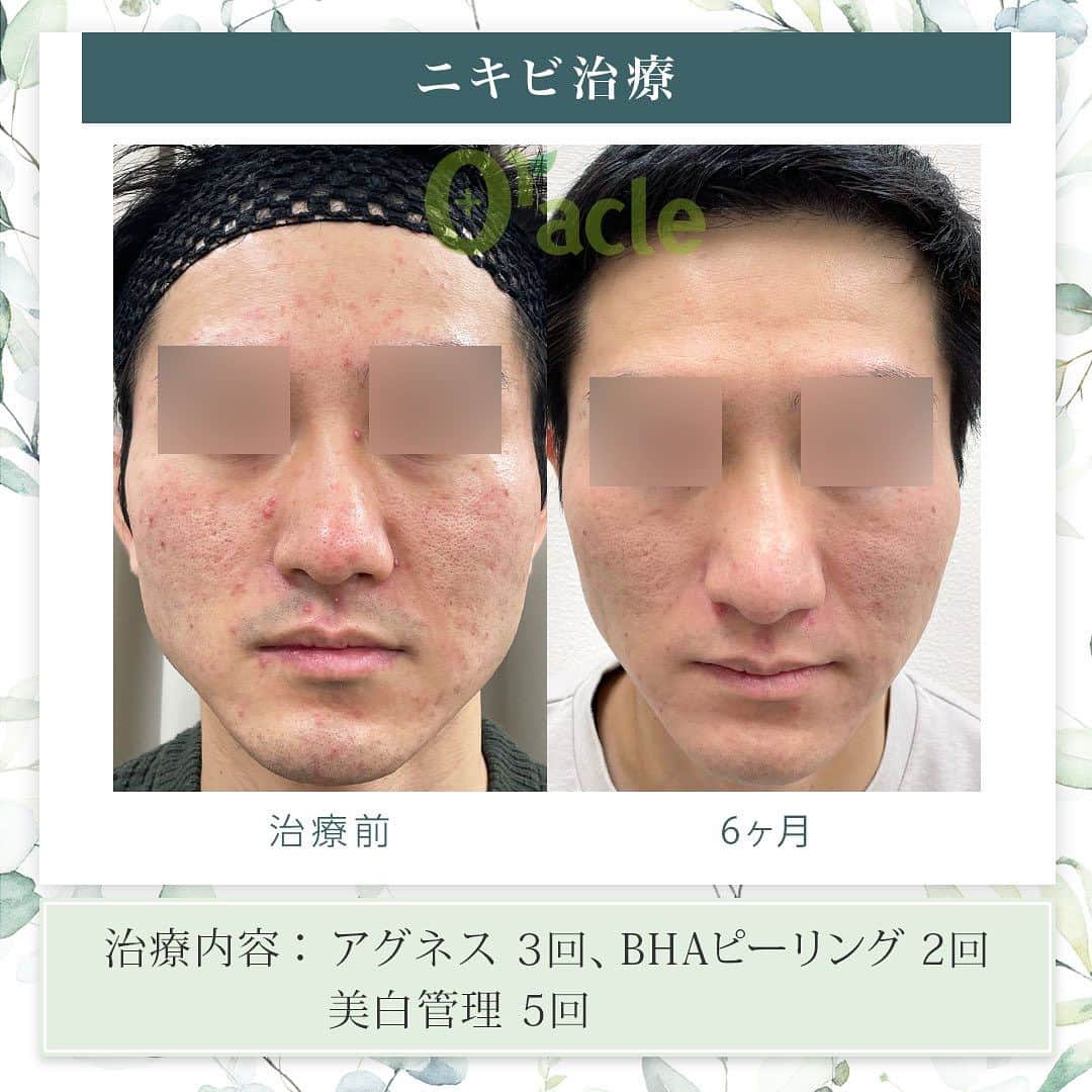 オラクル美容皮膚科東京新宿院さんのインスタグラム写真 - (オラクル美容皮膚科東京新宿院Instagram)「|◤ニキビ治療◢| ☞アグネス、BHAピーリング  《治療内容》 アグネス全顔3回 BHAピーリング2回 美白管理5回  ☑️アグネス ニキビの原因となる皮脂腺を直接破壊し、破壊した毛穴からの再発を半永久的に防ぐニキビの根本治療です。 ビリビリしたお痛みがあるので、麻酔をして痛みを軽減させます。 ⁡ 【ダウンタイム】 赤み：2~3日 腫れ：数日～2週間ほど出る方もいる 内出血：1~2週間 洗顔、メイクは翌日以降◎ ⁡ 【料金】 ☞初回部分　19,800円 ☞部分通常　22,000円 ①こめかみ片側 ②鼻（眉間〜鼻） ③顎 ①②③のいづれか1箇所  ☞⁡半顔　44,000円 ①額全体 ②頬片側 ③顎下～首 ①②③のいづれか1箇所  ☞全顔　66,000円 ※別途、麻酔代2,200円  ☑️BHAピーリング 高濃度サリチル酸ピーリングです。お肌の表面を殺菌し、繰り返し行うことでニキビはできづらいお肌に改善  【ダウンタイム】▶︎ほぼありません 赤み：数時間 皮剥け:1週間 洗顔、メイクは当日から◎ ⁡ 【料金】 1回　11,000円 ▶︎面ぽう圧出、ゴムパックつき  ☑️美白管理 ニキビのお肌は乾燥している方が多く、その乾燥がニキビの原因になっているいることも… 美白管理では、お肌の状態に合わせてビタミンＣ、もしくはトラネキサム酸をお肌に導入していきます。 ⁡ 【料金】 1回　11,000円(税込)  ※薬剤込▶︎トラネキサム酸orビタミンC ☞肌状態でお選びいたします。 ⁡ #アグネス #ニキビ治療 #ニキビ肌 #ニキビ跡 #ニキビケア #ニキビ肌 #ニキビ肌改善 #美肌 #肌質改善 #美肌男子　#美容男子 #韓国美容」8月6日 17時16分 - oraclejp