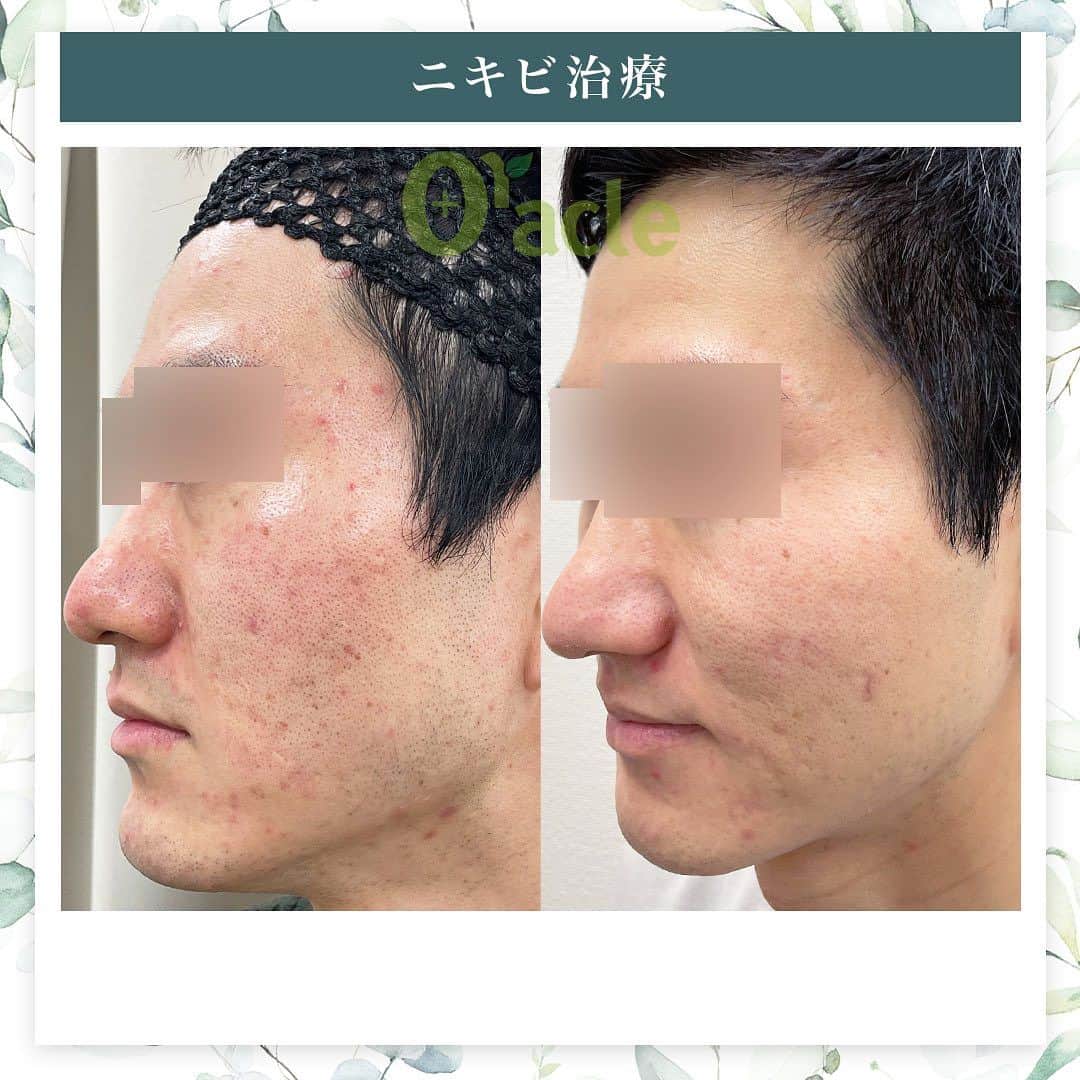 オラクル美容皮膚科東京新宿院さんのインスタグラム写真 - (オラクル美容皮膚科東京新宿院Instagram)「|◤ニキビ治療◢| ☞アグネス、BHAピーリング  《治療内容》 アグネス全顔3回 BHAピーリング2回 美白管理5回  ☑️アグネス ニキビの原因となる皮脂腺を直接破壊し、破壊した毛穴からの再発を半永久的に防ぐニキビの根本治療です。 ビリビリしたお痛みがあるので、麻酔をして痛みを軽減させます。 ⁡ 【ダウンタイム】 赤み：2~3日 腫れ：数日～2週間ほど出る方もいる 内出血：1~2週間 洗顔、メイクは翌日以降◎ ⁡ 【料金】 ☞初回部分　19,800円 ☞部分通常　22,000円 ①こめかみ片側 ②鼻（眉間〜鼻） ③顎 ①②③のいづれか1箇所  ☞⁡半顔　44,000円 ①額全体 ②頬片側 ③顎下～首 ①②③のいづれか1箇所  ☞全顔　66,000円 ※別途、麻酔代2,200円  ☑️BHAピーリング 高濃度サリチル酸ピーリングです。お肌の表面を殺菌し、繰り返し行うことでニキビはできづらいお肌に改善  【ダウンタイム】▶︎ほぼありません 赤み：数時間 皮剥け:1週間 洗顔、メイクは当日から◎ ⁡ 【料金】 1回　11,000円 ▶︎面ぽう圧出、ゴムパックつき  ☑️美白管理 ニキビのお肌は乾燥している方が多く、その乾燥がニキビの原因になっているいることも… 美白管理では、お肌の状態に合わせてビタミンＣ、もしくはトラネキサム酸をお肌に導入していきます。 ⁡ 【料金】 1回　11,000円(税込)  ※薬剤込▶︎トラネキサム酸orビタミンC ☞肌状態でお選びいたします。 ⁡ #アグネス #ニキビ治療 #ニキビ肌 #ニキビ跡 #ニキビケア #ニキビ肌 #ニキビ肌改善 #美肌 #肌質改善 #美肌男子　#美容男子 #韓国美容」8月6日 17時16分 - oraclejp