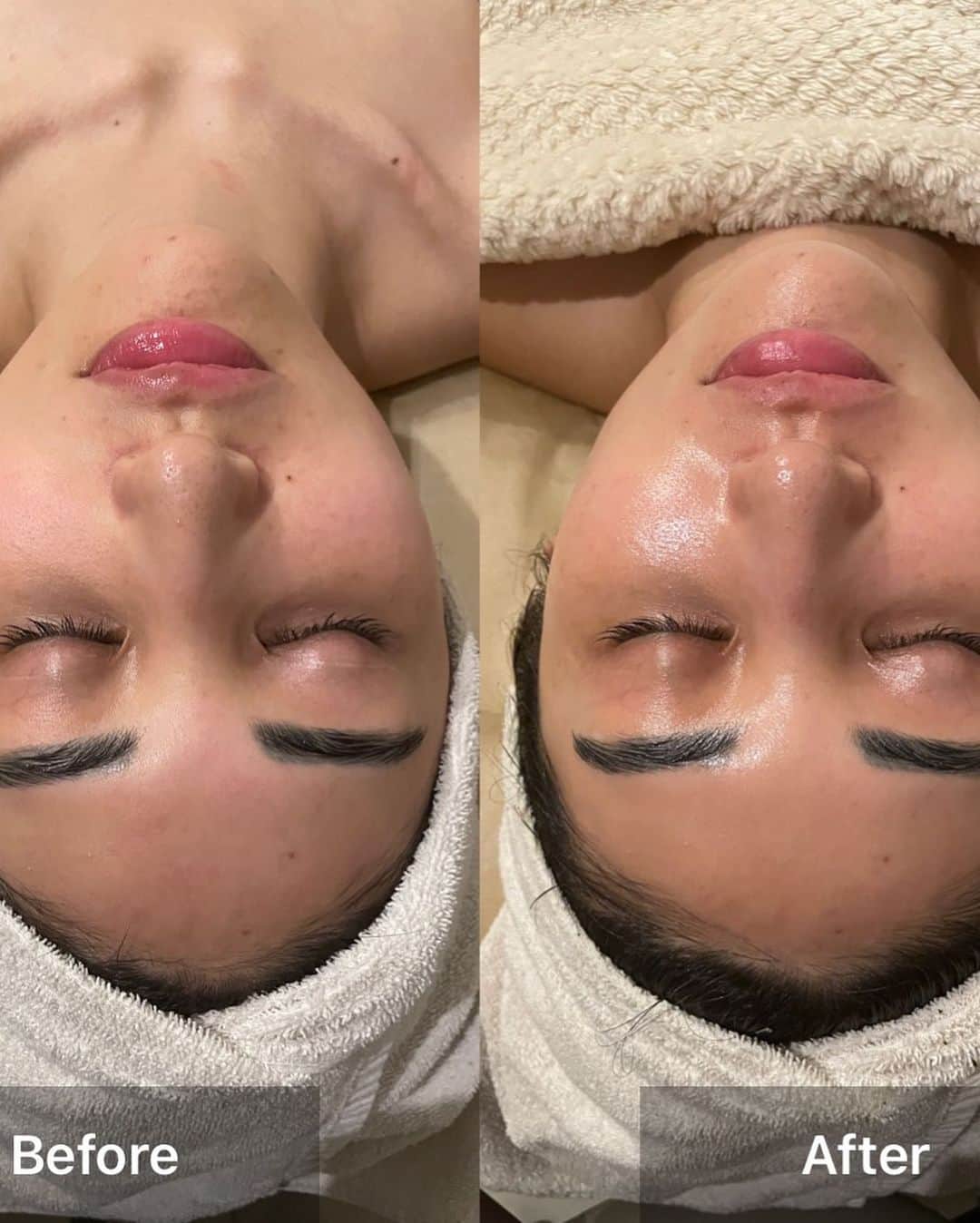 Lisaさんのインスタグラム写真 - (LisaInstagram)「. 少し久々に @salondec_ さんへ🩶 Christina大好きな私にとってほんとに神のような お店です❤️‍🔥前の店舗とすぐ近くだけど移転されて パワーアップされてました☺️☺️  今回はちょっと前に久々にアレルギーみたいな赤い プツプツが出たので相談し、肌状態見てもらって血管のつまりが影響の可能性があるとの事で、血行良くするためにビオフィートのハーブと、日焼けもしてるのでイラストリアスの組み合わせ施術をしてもらいました🥹🥹  肌の血行が良くなってアフターの肌の色とツヤが全然 違うのにびっくり🥹施術以降肌調子が良すぎてびっくりです🥲🥲肌に合わせて一種類のトリートメントではなく組み合わせをしてくれるのもサロンドシーさんならではです。  まだ日本で数人しかいないChristinaのトレーナーさん がいるのでめちゃくちゃ知識豊富で、肌悩みがあれば 絶対相談してみて欲しいです🫶🏻  私も昔あまりよく分からずクリニックで購入して Christina使ってた時は全然効果が分からなかったけど、 しっかり知識がある方に相談して選んでもらうとほんとに効果が違うのでスキンケアも物凄くChristina使ってます。  今回は色々聞いてForeveryoungが私のなりたい肌にすごく近かったのでお持ち帰りしました🤤🖤 成分や効果もしっかり理解して使うとより楽しいし使い分けしやすいです☺️  ほんとに知識豊富なサロンさんへ行くと勉強になる。 まだまだ知らないことばかり🥹 肌のことになると文章が長くなってしまうごめんなさい笑笑  ほんとに肌悩みある方、是非インスタも見に行ってみてください。beforeafter見たら行きたくなると思います☺️🩶 水野さんいつもありがとうございます🥲💓また色々教えてください🥹🫶🏻🩶🖤  #美肌#美肌ケア#お肌ケア」8月8日 13時25分 - lisarobintweety