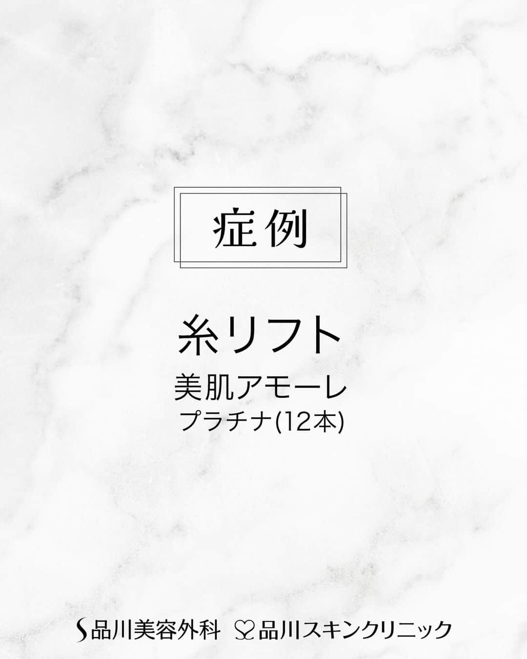 品川美容外科【公式】さんのインスタグラム写真 - (品川美容外科【公式】Instagram)「施術直後のお写真です✨ フェイスラインを整えてリフトアップ❣️ 　　 💎施術名 美肌アモーレ／プラチナ(12本) 　　 💎執刀医 品川美容外科 大宮院 塩野谷 匠 医師（@scs_omiya ) 　　　　　 ┈┈┈┈┈┈┈┈┈┈┈┈┈┈┈┈　 　　 【美肌アモーレ】 溶ける糸を挿入してタルミを引き上げ肌質を改善する施術 【価格】99,000円～578,600円(税込) 【副作用・リスク】腫れ／痛み：2日～1週間位 内出血：1～2週間位 針跡：数日～1週間位   【TEL】0120-564-800   ┈┈┈┈┈┈┈┈┈┈┈┈┈┈┈┈　　　   カウンセリングは無料です❣️是非ご相談ください✨   💎お問い合わせ 品川美容外科：0120-189-900 品川スキンクリニック：0120-575-900 プロフィール画面のURLからWEB予約が可能です💁 ▶@shinagawa.biyou   ※公的保険適用外となります。 ※掲載の全部または一部の治療は薬機法未承認の医療機器・医薬品を使用しています。医師の責任の下、個人輸入により治療を行っております。※個人輸入された医薬品等の使用によるリスク情報 https://www.yakubutsu.mhlw.go.jp/individualimport/   #品川美容外科 #品川スキンクリニック #美容 #美容医療 #美容皮膚科 #たるみ #美肌 #糸リフト #症例 #エイジングケア」8月10日 17時45分 - shinagawa.biyou