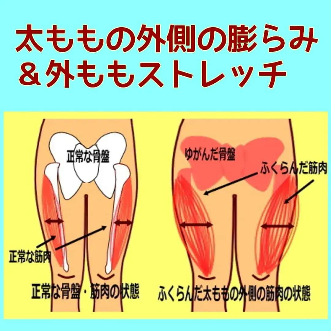 中目黒整体レメディオ 院長　渡邉潤一のインスタグラム：「太ももの外側が張り、脂肪がついてしまうのは、３つのプロセスにより起こります。  1) 骨盤のゆがみにより股関節がズレ、骨盤の横の出っ張り（大転子）が外側に張り出し、太ももの骨自体も外側に傾く。  2) 太もも外側にある筋肉が、傾いた骨を支えるため、筋肉には常に力が入り緊張した状態になり、筋肉は外側に膨らむ。  3) 太ももの外側が硬く緊張したことで代謝が下がり、脂肪の燃焼率が下がる。 また、筋肉のポンプ作用も低下するので、その部分のムクミが解消されず、脂肪と結合してセルライトになることでさらに膨らんだ状態になる。  太ももの外側が膨らんでいる方の特徴として、骨盤全体が前や後に傾いている方に多いです。 骨盤は前にゆがんでも後にゆがんでも必ず外側に開くように出来ています。 これは、骨盤を形成している仙骨と寛骨の関節面の形がそのように出来ているからです。  骨盤のゆがみはどのゆがみでも、太ももの外側の筋肉を緊張させ太くさせる原因になります。  ゆがみを取り除くことは、太ももを細くしたり下半身太りを解消するためには非常に重要です。  運動から始めるのは悪いわけではないですが、まずは根本のゆがみを取り除くことから始めると、より効果的に太もも痩せ、下半身痩せをすることができます。 . . . ーーーーーーーーーーーーーーーーーーーーー  💮施術のご案内💮 中目黒整体レメディオ：骨盤・美脚コース 施術をご希望の方は、はHPの予約フォームか、 お電話（0357735977）にてご連絡ください。  ーーーーーーーーーーーーーーーーーーーーー  #大転子 #大転子矯正 #o脚矯正 #x脚矯正 #膝下o脚 #XO脚 #骨格矯正 #骨盤矯正 #産後骨盤矯正 #下半身太り #下半身痩せ #太もも痩せ #ふくらはぎ痩せ #反り膝  #反り腰 #骨盤の歪み #整体 #レメディオ #姿勢矯正 #中目黒整体レメディオ #ダイエット #骨格診断 #太ももストレッチ」