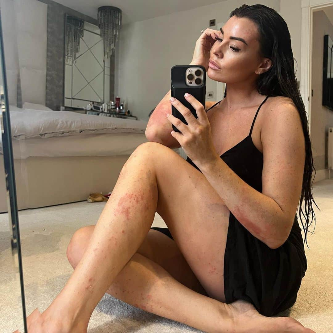 Jessica Wrightさんのインスタグラム写真 - (Jessica WrightInstagram)「This is me.   #psoriasisawarenessmonth」8月9日 16時26分 - jesswright77