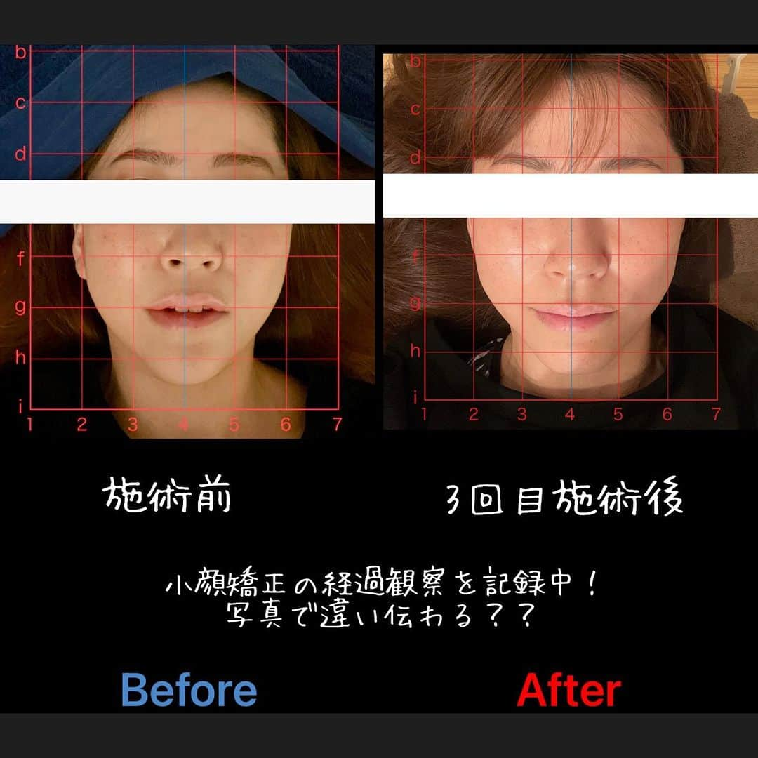 Ai Hagaさんのインスタグラム写真 - (Ai HagaInstagram)「小顔の経過観察中😊  個人的なセラピストの勉強の一環✨ 小顔は定着するまで平均7.8回かかるんだとか。  どう定着するのか体験したくて、経過観察中✨ 実は、エラの張りに悩みがあった私🥲 ダイエットしないと落ちないと思ってた‼️ でも、先生の施術2回目でエラが引っ込んでいるのを体感して感動😍✨  普段から食いしばってたり、噛み癖があったんだなぁって実感☺️ 顔痩せも頑張る💪  2回目の施術後に、同じく同じエラ張りに悩む新規のお客様の担当に✨ フェイシャル+小顔　60分コース に効果を体感😆💓  お客様から回数券を申し出て下さいました☺️ 施術楽しい^ ^ 綺麗を手助け出来て幸せです💓  写真の撮り方頑張らな😇  #ダイエット食 #ダイエット仲間募集 #ダイエット日記 #食生活改善 #食生活見直し #食生活の改善 #むくみ解消 #むくみ改善 #むくみケア #ダイエットモチベーション #ダイエット生活 #ボディメイク女子 #ボディーメイク #ボディメイクレシピ #姿勢改善ストレッチ #姿勢改善トレーニング #料理記録 #料理レシピ #料理好きな人と繋がりたい #ダイエット料理 #骨盤調整 #骨盤矯正ストレッチ #小顔マッサージ #小顔」8月11日 19時42分 - wruber722
