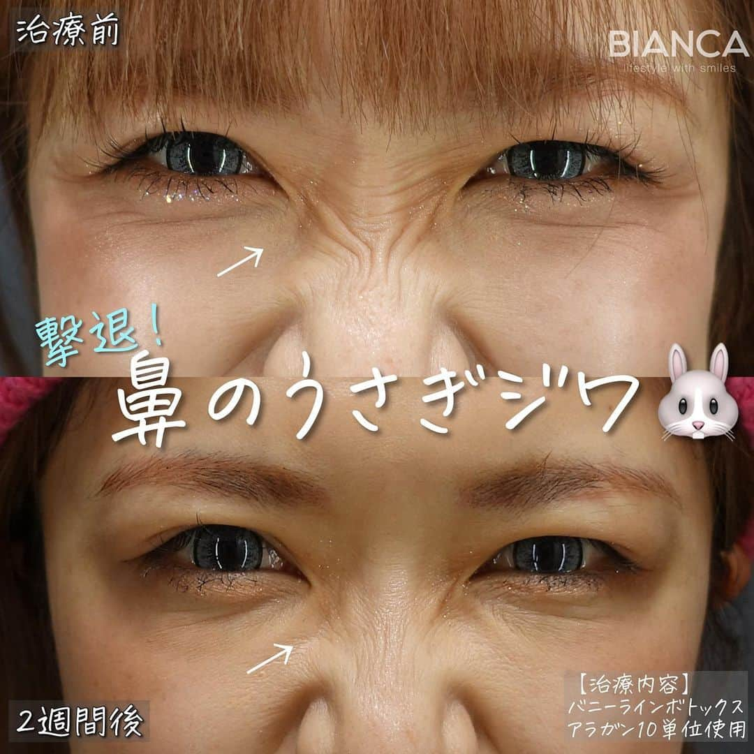 辻沢由有（BIANCA CLNIC 表参道院 院長）のインスタグラム：「バニーライン🐰ボトックス💉✨  鼻根の横ジワ、通称「バニーライン」 表情が豊かな方によく見られますが ボトックス注射で綺麗に治療できます☺️✨  ▶︎ボトックス注射 アラガン10単位使用 660円＋税/単位 別途施術料 22,000円＋税  ✽.｡.:*・ﾟ ✽.｡.:*・ﾟ ✽.｡.:*・ﾟ ✽.｡.:*・ﾟ ✽.｡.:*・ﾟ  📝ご予約はwebが便利です✨ プロフィール欄のリンクからご予約ください。 ※医師指名可能（“大久保医師指名”をクリック） ※診察料はかかりません🙅‍♀️ ※表参道院勤務が9割となっています。  📍BIANCA CLINIC ※お電話頂くと自動音声通話に繋がります。 ✔︎表参道院 ☎️05018071593 東京都港区南青山5-11-10  南青山511ビル 2F ✔︎銀座院 ☎️05031964834 東京都中央区銀座1-8-19 キラリトギンザ12F  •診療時間 10:00〜19:00 •年中無休（年末年始を除く）   ✽.｡.:*・ﾟ ✽.｡.:*・ﾟ ✽.｡.:*・ﾟ ✽.｡.:*・ﾟ ✽.｡.:*・  #ボトックス #バニーライン  #シワ改善  #ボトックス注射  #シワ対策」