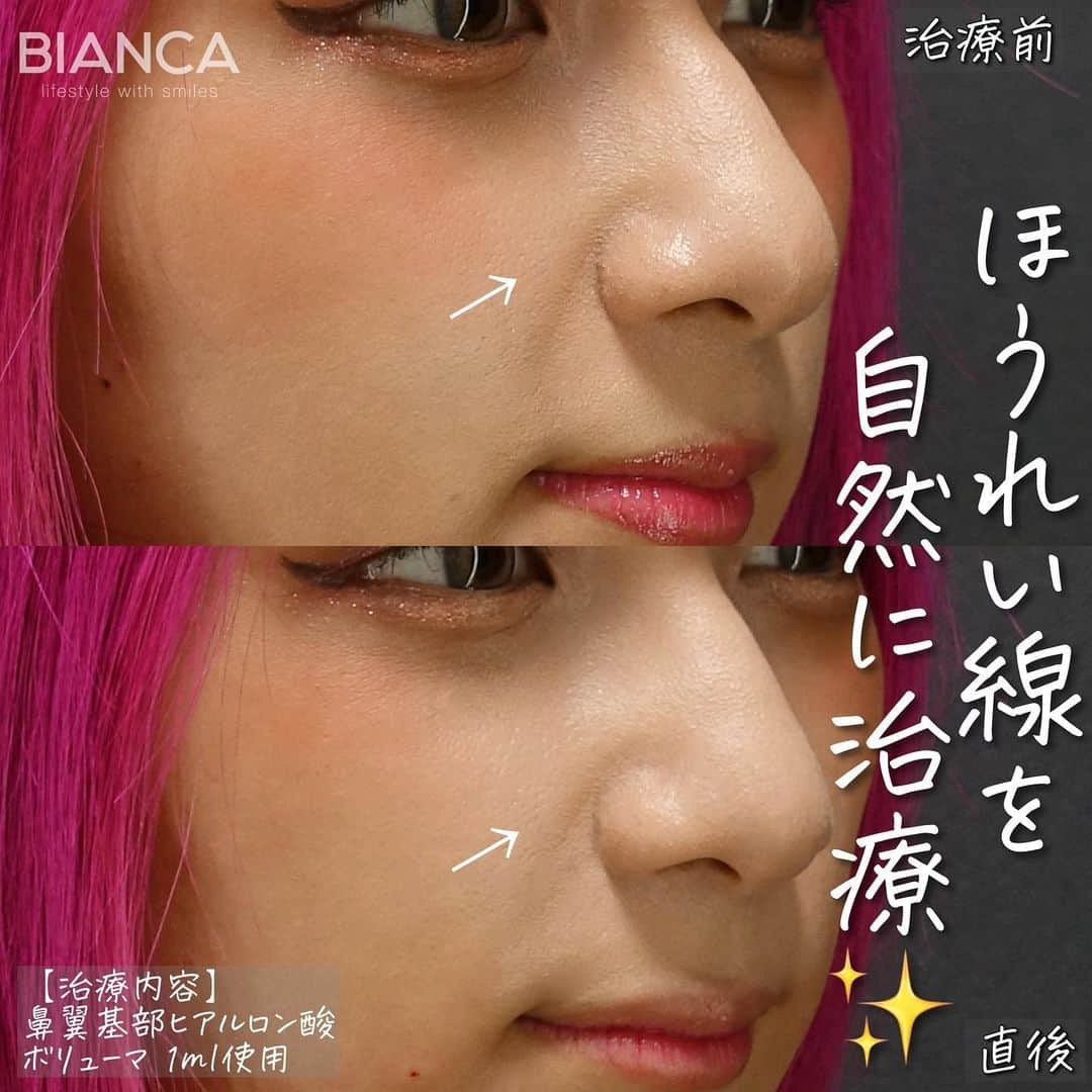 辻沢由有（BIANCA CLNIC 表参道院 院長）のインスタグラム：「#dryuuヒアル　 【ほうれい線撃退✨】  治療時間、約10分👏 ヒアルロン酸でお顔を更に洗練🎉  鼻翼基部の陥没はある程度しっかり ボリュームアップさせると ほうれい線を効率よく綺麗にできます✨  どうなりたいかわからない方も こだわりがたくさんある方も 綺麗になりたい方、お任せください🥰  ✽.｡.:*・ﾟ ✽.｡.:*・ﾟ ✽.｡.:*・ﾟ ✽.｡.:*・ﾟ ✽.｡.:*・ﾟ  ✔︎鼻翼基部ヒアルロン酸 ボリューマ 1ml  77,000円＋税 別途施術料　22,000円＋税  ⏳治療時間: 10分 🗓持続期間: 1〜2年 😷腫れ・内出血: 数日程度 ⚠️リスク: 感染・血流障害・凹凸など  ✽.｡.:*・ﾟ ✽.｡.:*・ﾟ ✽.｡.:*・ﾟ ✽.｡.:*・ﾟ ✽.｡.:*・ﾟ  📝ご予約はwebが便利です✨ プロフィール欄のリンクからご予約ください。 ※医師指名可能（“大久保医師指名”をクリック） ※診察料はかかりません🙅‍♀️ ※表参道院勤務が9割となっています。  📍BIANCA CLINIC ※お電話頂くと自動音声通話に繋がります。 ✔︎表参道院 ☎️05018071593 東京都港区南青山5-11-10  南青山511ビル 2F ✔︎銀座院 ☎️05031964834 東京都中央区銀座1-8-19 キラリトギンザ12F  •診療時間 10:00〜19:00 •年中無休（年末年始を除く）   ✽.｡.:*・ﾟ ✽.｡.:*・ﾟ ✽.｡.:*・ﾟ ✽.｡.:*・ﾟ ✽.｡.:*・ﾟ  #ヒアルロン酸  #ほうれい線 #鼻翼基部 #鼻翼基部ヒアルロン酸 #貴族手術」