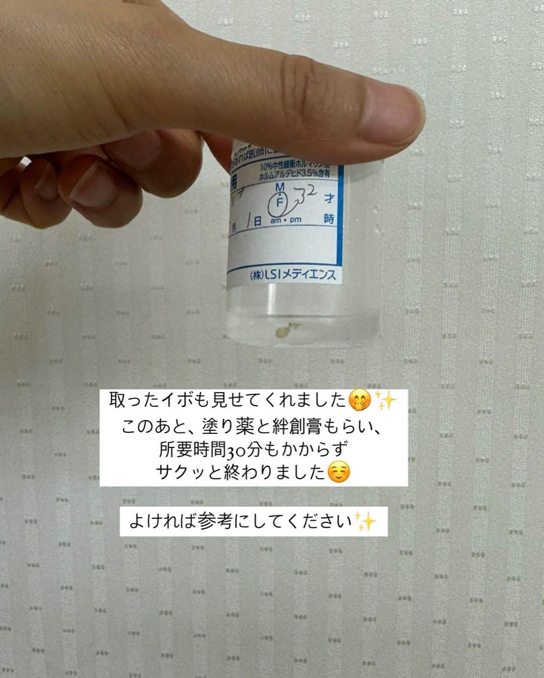 りーまるさんのインスタグラム写真 - (りーまるInstagram)「手にできたイボを取りました！ リアル投稿なので傷が苦手な人はキャプションだけ読んでね🙇 ▶︎▶︎▶︎  📍@ikesunshine331244  左手薬指に突如できてしまったイボ。  ホクロ、イボ取りで口コミがよかった、 池袋サンシャインクリニックに てお願いしました。  所要時間は10分もなく、 麻酔をして3分後にはイボ取り完了！  痛みもそこまでなかったです🥰  皮膚からえぐって取るので、 完全に治るまで1ヶ月はかかるそう✍️  よければ参考にしてね🥰  #PR #池袋サンシャイン美容外科  #美容クリニック #池袋東口 #池袋 #当日治療 #美容医療 #美容皮膚科 #美肌ケア #いぼ除去 #保険 #保険診療 #レーザー除去 #レーザー治療#美容クリニック東京」9月7日 19時41分 - riii_maru162cm