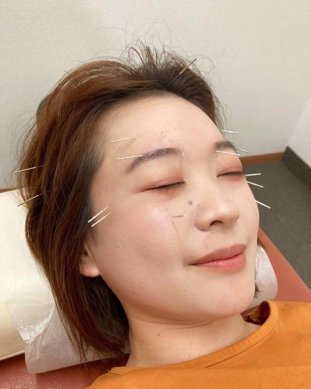 有田優理香さんのインスタグラム写真 - (有田優理香Instagram)「💆‍♀️  新潟帰省ふり返り②  中学水泳部の先輩のはり灸院(@takayama_hari )で 施術していただきました🙏  インスタをフォローいただいてから ずっと行きたいと思っていて！ タイミングが合ってやっと行くことができました😊  パソコン画面とにらめっこしながら仕事することが多くて 目が疲れ切っていたので 眼精疲労に効く鍼治療をお願いしました🌷  初めての鍼治療！ うお〜入ってる〜！って最初は不思議な感覚でしたが、 時間が経つにつれて心地よくなって 終わった時には超スッキリしました！！ 鍼すごーーーー✨✨  懐かしいお話もいっぱいでき楽しい時間でした😆 帰省したらまた伺います！ ありがとうございました🙇‍♀️  #高山はり灸治療院 #新潟鍼灸院 #新潟市鍼灸院 #巻西中学校 #水泳部 #zip #がんばります 💪」9月8日 18時32分 - yurikaa0624