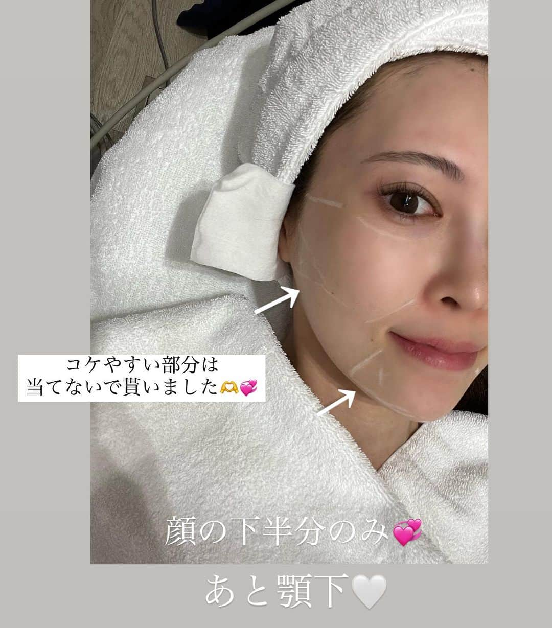 清水愛美さんのインスタグラム写真 - (清水愛美Instagram)「お肌がキュッと引き締まって、 最近気分も上がってます！  大大大好きなサーマクールを 1年以上ぶりにやってきました！ @dahliagsc  お肌の事はいつもお任せしてます！  年々お悩みも変わってきて、 昔はアンパンマンみたいな丸い顔が 嫌で、脂肪をなくしたい！ と考えていましたが、 今では顔に脂肪がつきにくくなりました！🥹そしてコケてくる部分が😇  サーマクールは肌の引き締めなので 私には凄い合ってる！ ですが当てる部位は気をつけなきゃ いけないのでしっかり マーキングをしながらやってもらいましたよ！ (昔は全顔当ててました😅) 今は顔の下半分のみ☺️ あと、顎下！  直後から効果を実感出来て、 肌触りも良くなって、 大満足🥹💞また来年やりたいです笑  #ダリア銀座スキンクリニック #ダリア銀座　 #ダリア美肌 #スキンケア #美容皮膚科 #サーマクール」8月17日 22時26分 - manami_s0902