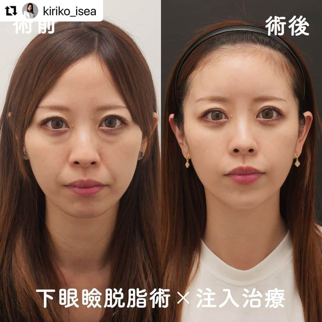 東京イセアクリニックさんのインスタグラム写真 - (東京イセアクリニックInstagram)「▶︎▷▶︎ 目の下のクマ取り×注入治療💉  ▼執刀医 Dr.大山 希里子　@kiriko_isea   ==== 詳 細 ====  ■下眼瞼脱脂術　¥298,000(税込)  ■ヒアルロン酸 額　¥297,000(税込) 法令線　¥154,000(税込)　 あご　¥132,000(税込) 唇　¥121,000(税込)  ■ボトックス ガミー　¥44,000(税込) 口角　¥44,000(税込)  リスク 下眼瞼脱脂術：凹み、くぼみ、感染、左右差が生じる、小ジワや皮膚のたるみが目立つ可能性 ヒアルロン酸：感染・塞栓・アレルギー反応 ボトックス：感染・アレルギー反応   #アンチエイジング効果 #アンチエイジング #アンチエイジングの鬼 #アンチエイジングケア #垢抜け #垢抜けたい #垢抜け方法 #垢抜ける方法 #クマ取り #クマ取り手術 #クマ取り経過 #下眼瞼脱脂 #下眼瞼脱脂術 #下眼瞼脱脂術ダウンタイム #下眼瞼脱脂経過 #ヒアルロン酸 #ヒアルロン酸注射 #ヒアルロン酸注入 #額ヒアルロン酸注入 #額ヒアルロン酸 #額ヒアルロン酸注射 #顎ヒアルロン酸 #顎ヒアルロン酸注入 #顎ヒアルロン酸注射 #顎ヒアルロン酸入れたい #唇ヒアルロン酸 #唇ヒアルロン酸注入 #唇ヒアルロン酸注射 #法令線ヒアルロン酸 #ボトックス注射」8月18日 13時01分 - iseaclinic