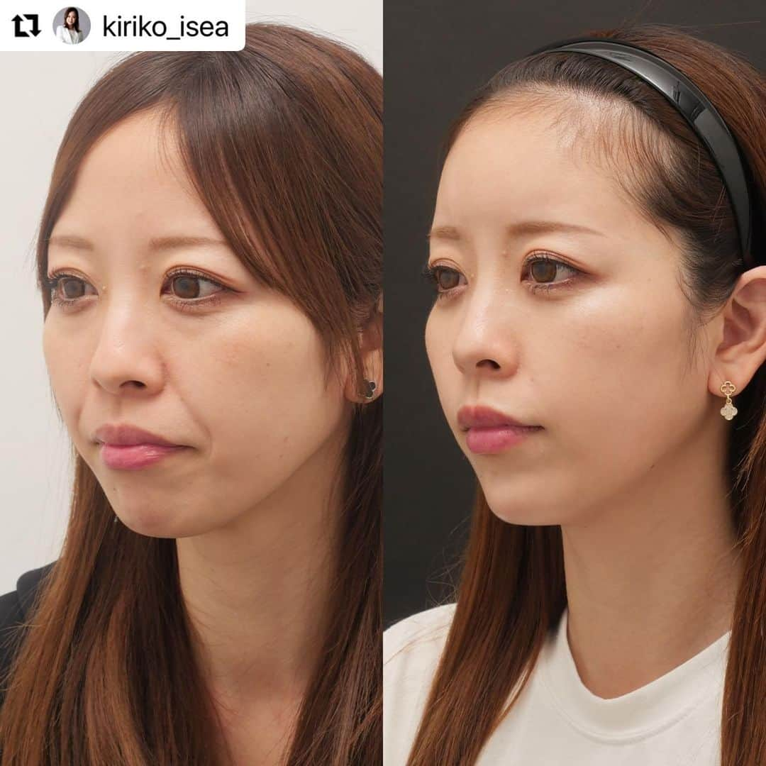 東京イセアクリニックさんのインスタグラム写真 - (東京イセアクリニックInstagram)「▶︎▷▶︎ 目の下のクマ取り×注入治療💉  ▼執刀医 Dr.大山 希里子　@kiriko_isea   ==== 詳 細 ====  ■下眼瞼脱脂術　¥298,000(税込)  ■ヒアルロン酸 額　¥297,000(税込) 法令線　¥154,000(税込)　 あご　¥132,000(税込) 唇　¥121,000(税込)  ■ボトックス ガミー　¥44,000(税込) 口角　¥44,000(税込)  リスク 下眼瞼脱脂術：凹み、くぼみ、感染、左右差が生じる、小ジワや皮膚のたるみが目立つ可能性 ヒアルロン酸：感染・塞栓・アレルギー反応 ボトックス：感染・アレルギー反応   #アンチエイジング効果 #アンチエイジング #アンチエイジングの鬼 #アンチエイジングケア #垢抜け #垢抜けたい #垢抜け方法 #垢抜ける方法 #クマ取り #クマ取り手術 #クマ取り経過 #下眼瞼脱脂 #下眼瞼脱脂術 #下眼瞼脱脂術ダウンタイム #下眼瞼脱脂経過 #ヒアルロン酸 #ヒアルロン酸注射 #ヒアルロン酸注入 #額ヒアルロン酸注入 #額ヒアルロン酸 #額ヒアルロン酸注射 #顎ヒアルロン酸 #顎ヒアルロン酸注入 #顎ヒアルロン酸注射 #顎ヒアルロン酸入れたい #唇ヒアルロン酸 #唇ヒアルロン酸注入 #唇ヒアルロン酸注射 #法令線ヒアルロン酸 #ボトックス注射」8月18日 13時01分 - iseaclinic