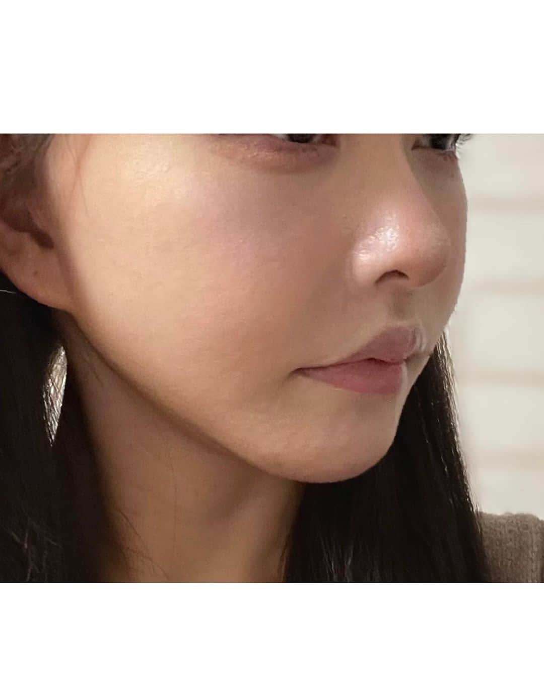 RINKAさんのインスタグラム写真 - (RINKAInstagram)「. 今回韓国にきた目的の一つ。 . アバント美容外科さんで( @avant_ps_jp ) ずっと気になってた唇の左右差や 口角の下がり具合や口元のもたつきを 改善することにしました🏥 . いろんなところにカウンセリングいったり 自分なりに色々調べて唇の専門の先生で症例写真も すごく綺麗だったのでアバントさんにきめました。 . 3枚目からはノーマルカメラの現在📷 . ビフォーアフターはまたのせますね💉 . 明日からしばらく口を大きく 開けれないのでこれ食べて寝ます🫖 . 怖いけど気になってた事が解決すると思うと楽しみ。 . #韓国美容整形 #韓国美容#アバント美容外科#口角挙上」8月18日 19時57分 - rinka.716