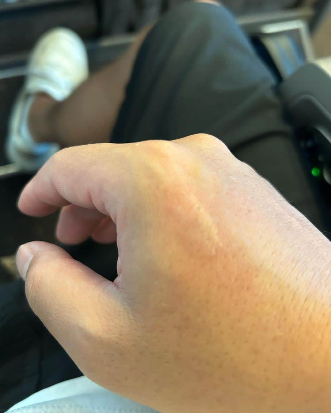 津田篤宏のインスタグラム：「やってもうた！トカゲのゲージ掃除してたらライトでジュッとしてしまった！痛い！ジンジンする！久々の火傷！痛い！腹立つ！ #痛い #火傷 #くそう！」