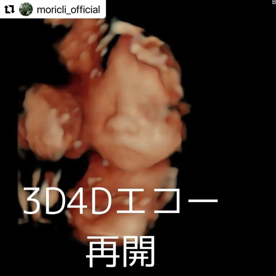 宋美玄さんのインスタグラム写真 - (宋美玄Instagram)「#Repost @moricli_official with @use.repost ・・・ 3D/4Dエコーを再開します！！ 📢超音波技師からのお知らせ📢  9月より、多数のご要望にお答えして妊婦さんの3D/4Dエコーを再開します！！  3D/4Dエコとは、赤ちゃんの姿を立体的に見られるエコーです。 従来の3D（奥行き、幅、高さ）のエコーに加えて、4Dエコーは「時間軸」が加わり、あくびや伸びなどの赤ちゃんのかわいいしぐさが見られることも！  タイミングによっては、背中を向けていることもあります💔(T_T)  診断はしませんが、赤ちゃんの姿を立体的に見てみたい、という方におすすめです(^^)✨ 画像データはお土産にお持ち帰り頂けます。  #赤ちゃん  #プレママライフ  #妊婦生活 #妊婦 #妊娠中 #妊婦健診 #赤ちゃんのいる生活 #親バカ部 #男の子ベビー #女の子ベビー #新米ママ #成長記録 #子育て #丸の内の森レディースクリニック #丸の内 #エコー写真」8月21日 10時58分 - mihyonsongkobe