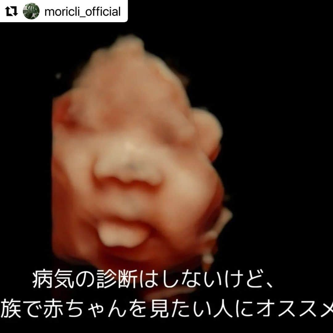 宋美玄さんのインスタグラム写真 - (宋美玄Instagram)「#Repost @moricli_official with @use.repost ・・・ 3D/4Dエコーを再開します！！ 📢超音波技師からのお知らせ📢  9月より、多数のご要望にお答えして妊婦さんの3D/4Dエコーを再開します！！  3D/4Dエコとは、赤ちゃんの姿を立体的に見られるエコーです。 従来の3D（奥行き、幅、高さ）のエコーに加えて、4Dエコーは「時間軸」が加わり、あくびや伸びなどの赤ちゃんのかわいいしぐさが見られることも！  タイミングによっては、背中を向けていることもあります💔(T_T)  診断はしませんが、赤ちゃんの姿を立体的に見てみたい、という方におすすめです(^^)✨ 画像データはお土産にお持ち帰り頂けます。  #赤ちゃん  #プレママライフ  #妊婦生活 #妊婦 #妊娠中 #妊婦健診 #赤ちゃんのいる生活 #親バカ部 #男の子ベビー #女の子ベビー #新米ママ #成長記録 #子育て #丸の内の森レディースクリニック #丸の内 #エコー写真」8月21日 10時58分 - mihyonsongkobe