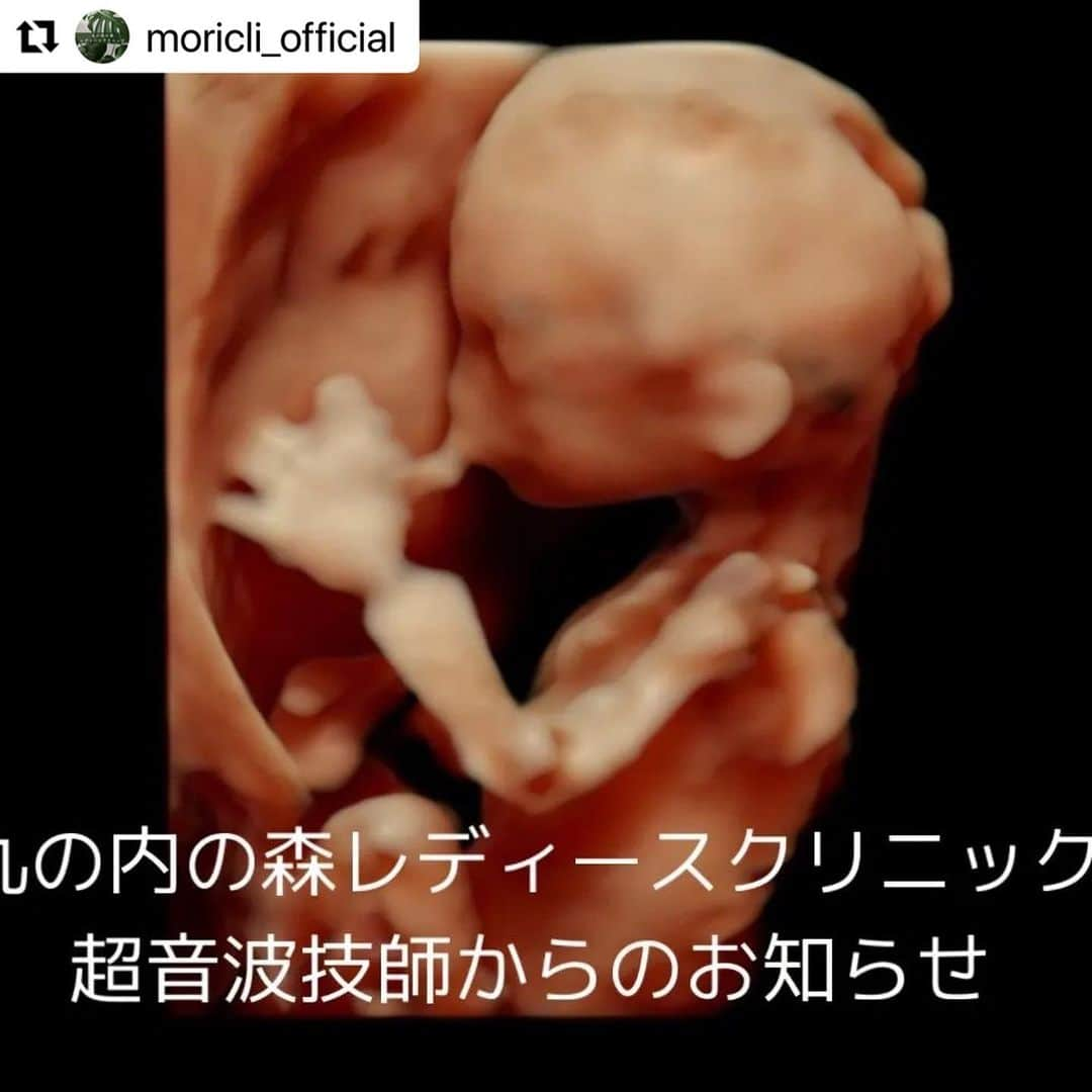 宋美玄のインスタグラム：「#Repost @moricli_official with @use.repost ・・・ 3D/4Dエコーを再開します！！ 📢超音波技師からのお知らせ📢  9月より、多数のご要望にお答えして妊婦さんの3D/4Dエコーを再開します！！  3D/4Dエコとは、赤ちゃんの姿を立体的に見られるエコーです。 従来の3D（奥行き、幅、高さ）のエコーに加えて、4Dエコーは「時間軸」が加わり、あくびや伸びなどの赤ちゃんのかわいいしぐさが見られることも！  タイミングによっては、背中を向けていることもあります💔(T_T)  診断はしませんが、赤ちゃんの姿を立体的に見てみたい、という方におすすめです(^^)✨ 画像データはお土産にお持ち帰り頂けます。  #赤ちゃん  #プレママライフ  #妊婦生活 #妊婦 #妊娠中 #妊婦健診 #赤ちゃんのいる生活 #親バカ部 #男の子ベビー #女の子ベビー #新米ママ #成長記録 #子育て #丸の内の森レディースクリニック #丸の内 #エコー写真」