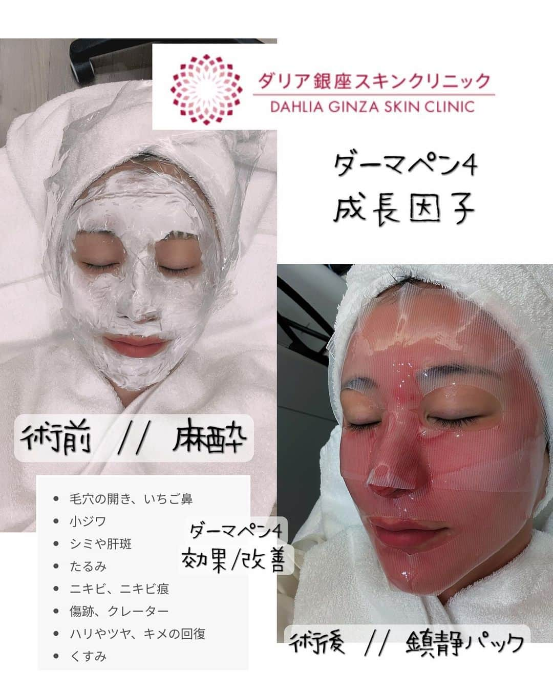 中村江莉香さんのインスタグラム写真 - (中村江莉香Instagram)「#美容撮影 📷💆‍♀️ 大切な撮影が週末から続くので... 今だ‼️と思い#ダーマペン4 ➕成長因子して来ました💉⚠️ #絶賛ダウンタイム 突入🤕🩸  #肌治療 は昨年10月に#ポテンツァ をしたぶりです🏥 ホームケアをこつこつしながらも、毛穴の開きと肌のハリツヤの衰えを感じて#ダリア銀座スキンクリニック へ🥹🩷  #ダリア銀座 のドクターはカウンセリングがとても丁寧で安心して施術が出来る♡♡ 私は肌が薄いので、レーザー治療をすると肌の赤みが増えたり、肌が弱くなってゆくのを感じるので、針を使う施術が合っている🤔‼︎ (私は混合肌で鼻や顎は皮脂が多く、頬や額は乾燥気味です🤫) 詳しくレポートはブログに書きます📝  @dahliagsc ☜私の投稿を見ました！と、お伝え頂くと初診の施術が1割引きでご案内してくださるそうなので、気になる方は是非行かれてみてくださいね🫶  #美容撮影📷 #肌管理 #エイジングケア #ダリア美肌 #スキンケア #美容皮膚科 #ダーマペン #美容外科 #美容皮膚科 #美容 #美容整形 #美肌 #beauty #クリニック #美魔女 #ニキビ #若返り #モニター募集 #美意識 #肌質改善 #ニキビ跡 #たるみ #モデル #ビタミンc」8月21日 15時21分 - erica_nakamura