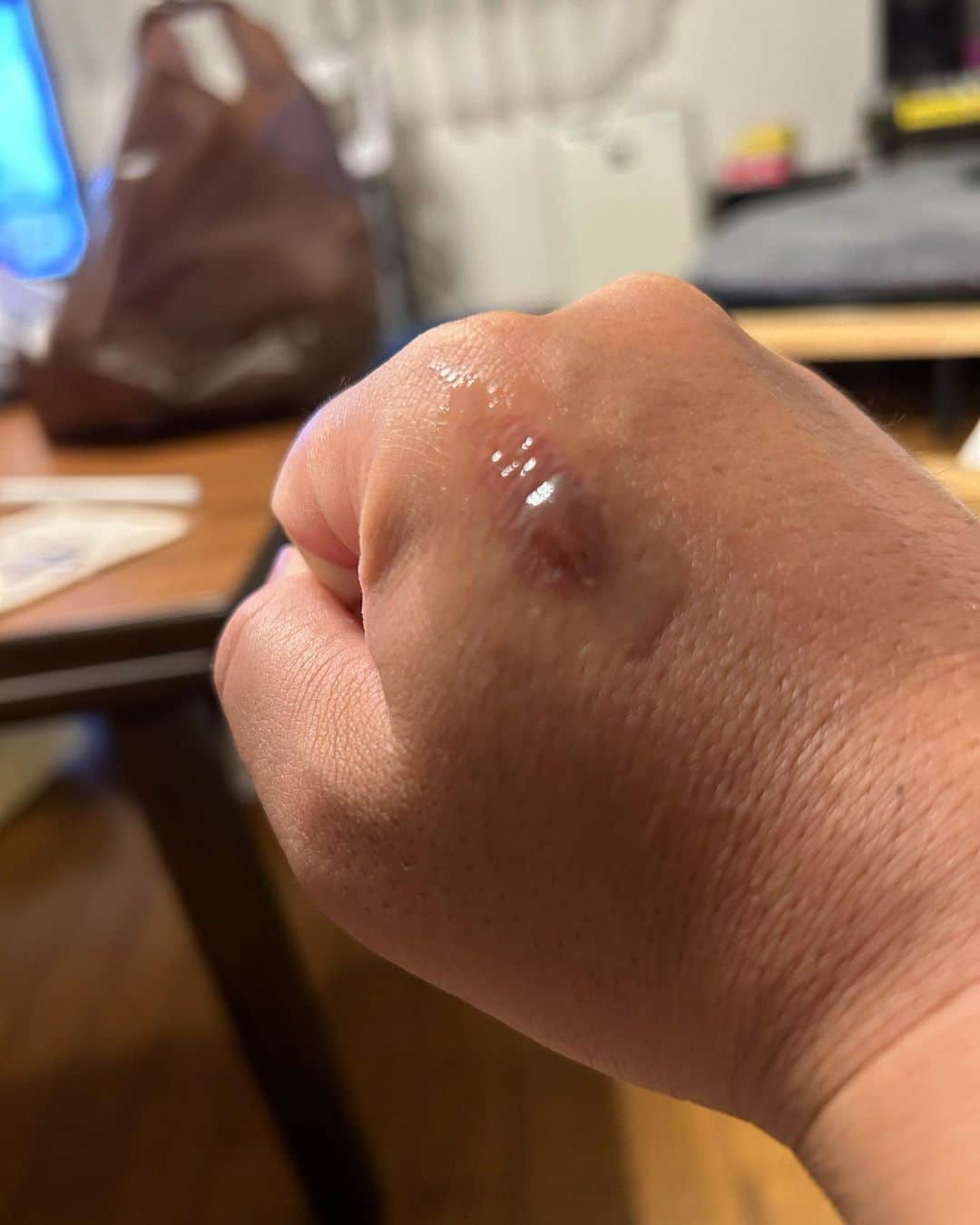 津田篤宏のインスタグラム：「すんごいみずぶくれになってきたー やぶれるのこわいー きょわーい やだーきょわーい #破れそうで怖い」
