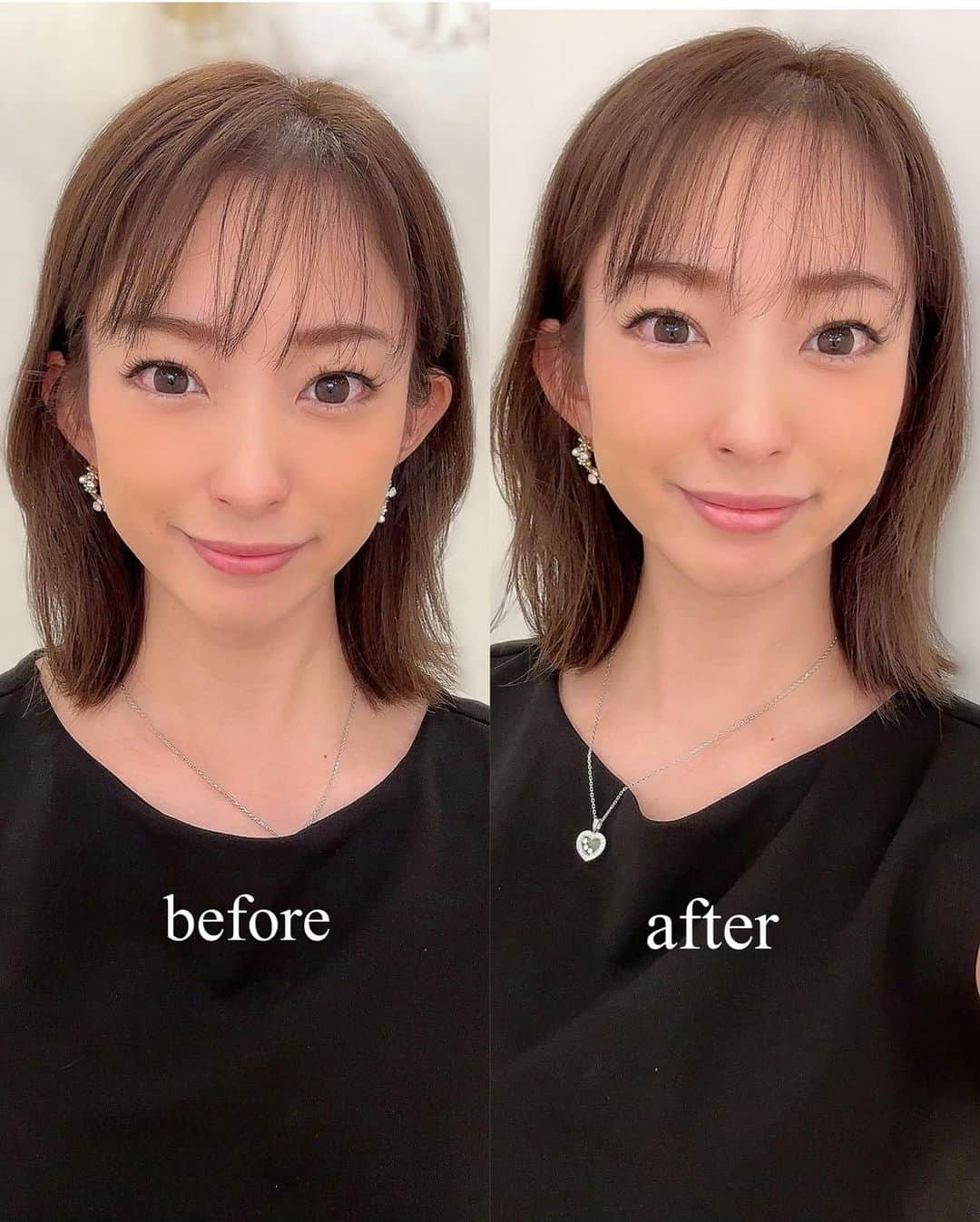 RIKAさんのインスタグラム写真 - (RIKAInstagram)「@a_clinic_ginza の木家先生　@aclinic_kiya にAスレッドを受けてきました💄  立て続けの出産と育児に追われ子供のオムツやお着替えで下を向く事が多く顔のたるみが最近の悩み🥲 更に寝る時は横向き（右）で左右のバランスも気になっていたので今回Aクリニックの木家先生に相談してAスレッドを受けることになったよー✨  前日まではちょっとドキドキだったけど、施術室がメイク室みたいですごくリラックスして施術ができたのと先生とスタッフさんの手際が良すぎてあっという間に終わった🫢  すぐ終わったのに顔がシュッとなってたるみもなくなった‼︎スゴイー✨  次回は点滴系やってみたいな❤︎ 冷え性改善点滴っていうのがあるんだけど代謝の悪い私に効果ありそう🤭🤭  @a_clinic_ginza  @aclinic_kiya   #aスレッド #糸リフト #aclinic #aclinic銀座 #aclinic横浜 #aclinic新宿 #aclinic名古屋 #aclinic大阪 #aclinic福岡 #aclinic池袋 #acllinic仙台 #aクリニック #エークリニック#小顔 #リフトアップ #スレッドリフト #小顔整形 #たるみ改善 #美容外科 #美容皮膚科 #美容クリニック#木家祐理子」8月23日 12時58分 - rinrikagolf