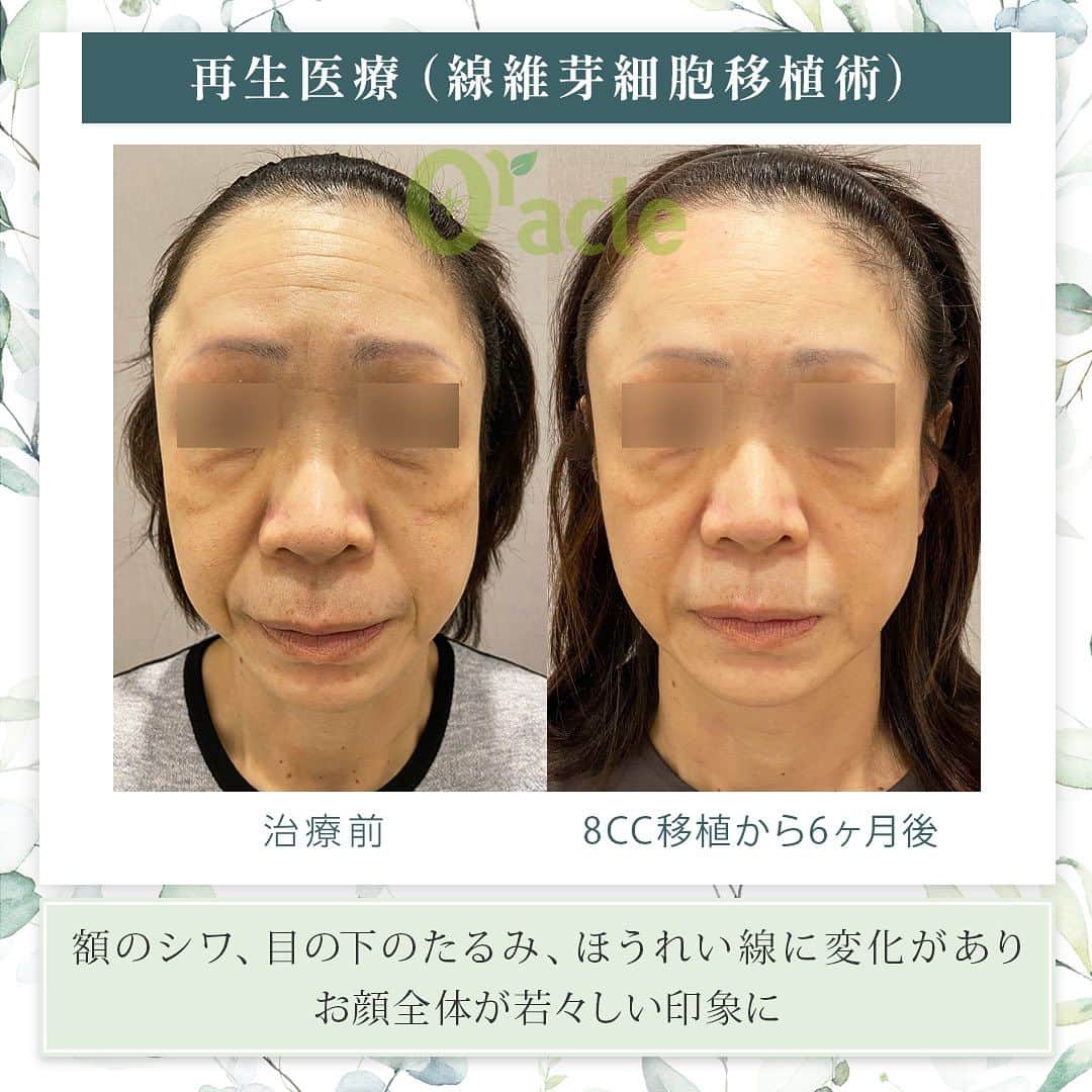 オラクル美容皮膚科東京新宿院さんのインスタグラム写真 - (オラクル美容皮膚科東京新宿院Instagram)「◤ 肌の再生医療（セルバンク） ◢| ※当院の再生医療は北條元治先生の自家培養真皮線維芽細胞移植です。  🩺現在は新宿院の古市統括院長のみ再生医療を担当しております。  《治療内容》 8CC 移植 ※移植回数は4CC×2回 ※特に目周りの小じわや額のシワが改善 　見た目年齢層が10歳以上若々しくなられました。 ☞モニターさんも想像以上の効果に大変満足されておりました。  気になる箇所は手打ちで、お顔全体は機械で移植します。  《治療内容の詳細》 日焼けなどのダメージの少ない耳の裏から皮膚を採取し、（米粒～小さじ一杯分程度の大きさ） その皮膚から細胞を取り出し専用の施設で培養し10,000倍に細胞の数を増やし 増やした細胞をもう一度お肌に戻す再生医療です。 細胞が増えることでお肌にハリや潤いを与えお肌全体を若返らせる治療です。  ⚠️副作用・リスク等 ご自身の細胞のため副作用は極めて低いですが 一般的な医療行為と同じように内出血、色素沈着の可能性があります。  【料金】 セルバンクの初診料​	5,500円 血液検査​	11,000円 細胞採取・培養	　495,000円 初回移植1回目（1ccの場合）	151,800円 初回移植2回目（1ccの場合）	151,800円  【移植料金】 1cc 151,800円 2cc 303,600円 3cc 455,400円 4cc 607,200円  上記の他、細胞を保管する場合 細胞保管料：11,000円／月  🉐モニタープラン（Aプラン、Bプラン、Cプラン）のご用意もございます。  詳しくはオラクル美容皮膚科公式サイトにてご確認お願い致します。  #再生医療 #肌の再生医療 #セルバンク #北條先生　#北條元治  #若返り #アンチエイジング #おでこのシワ　#たるみ　#目まわりのシワ」8月23日 19時12分 - oraclejp