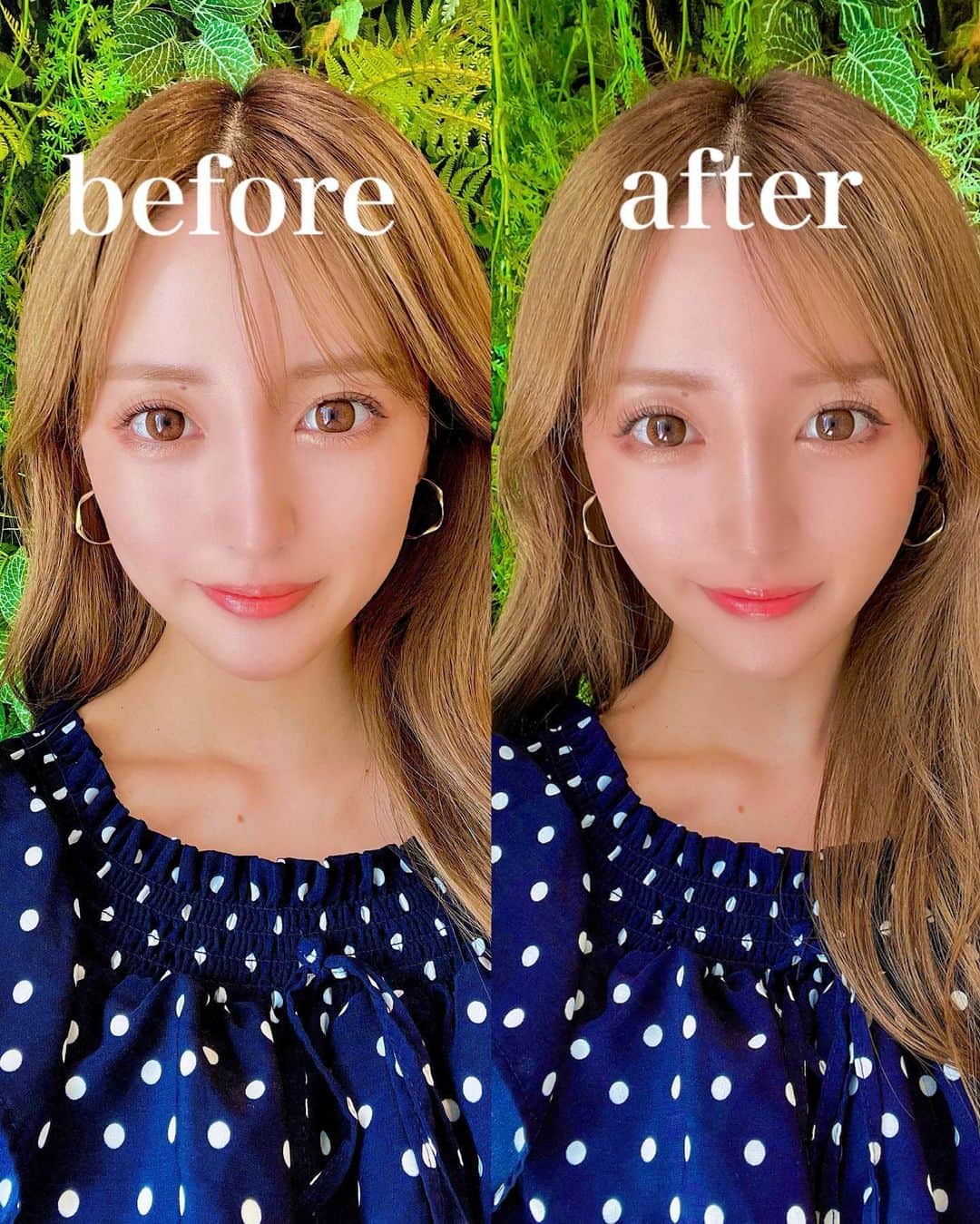 SAYAさんのインスタグラム写真 - (SAYAInstagram)「. . ナチュラルハーモニークリニック表参道 @nhc_clinic  幹細胞のフェイスリフトは初めてで 気になったから受けて来た💛 耳の上から入れるリフトも初めてで あごから入れるリフトと引き上げ力が 違うし、すごく小顔になって やって大満足😍 左右3本ずつ入れたよ〜！ スタッフさんも先生も優しくて 安心して受けられた🥹 店内もめちゃ可愛くて行くだけで テンション上がる空間でした💕 . . #糸リフト　#幹細胞フェイスリフト　#ナチュラルハーモニークリニック表参道　#NHC #表参道 #美容 #小顔 #リフトアップ #美容外科 #美容皮膚科 #美容クリニック #幹細胞上清液　#再生医療  #フェイスリフト #スレッドリフト #リフトアップ」8月25日 13時01分 - sayapi0110