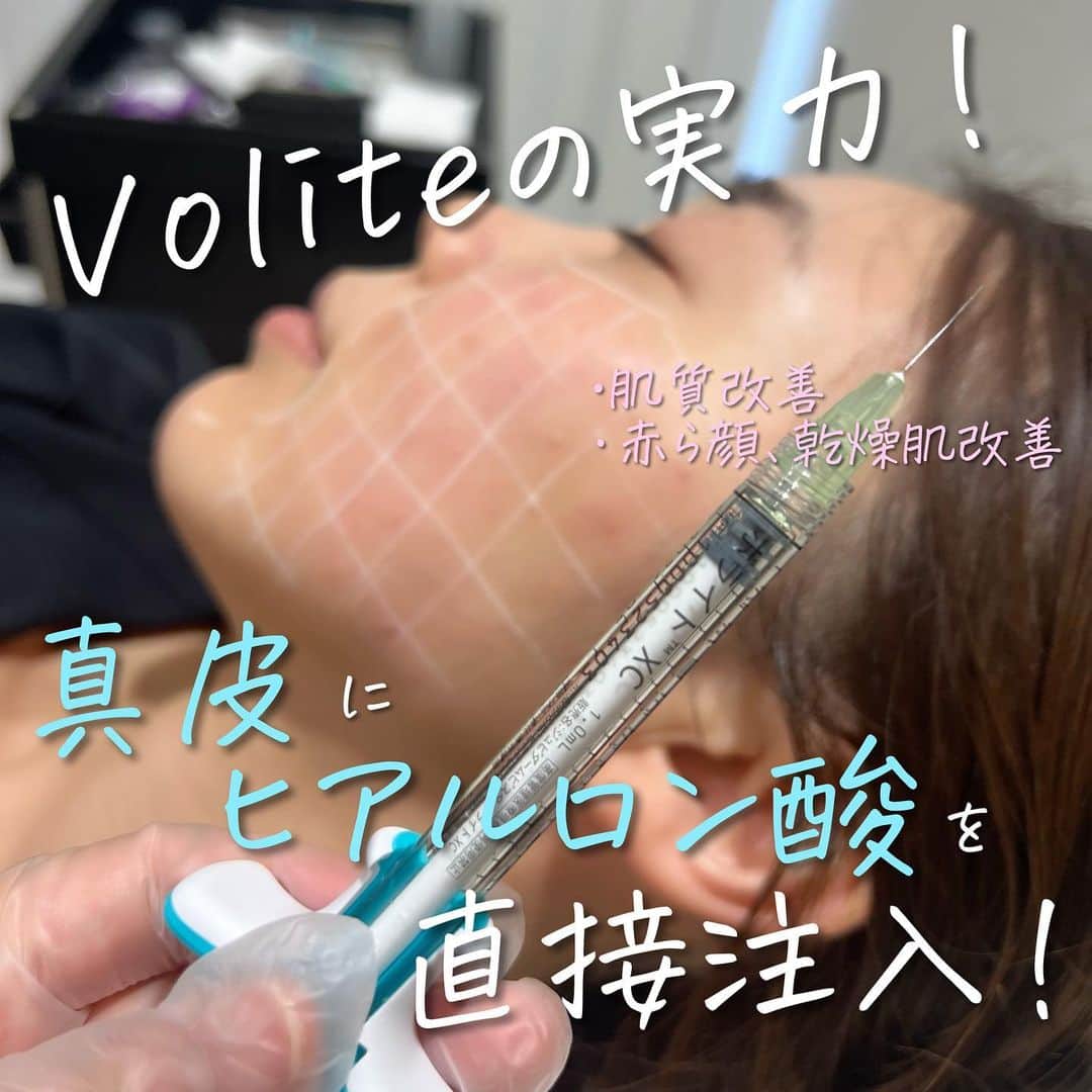 辻沢由有（BIANCA CLNIC 表参道院 院長）さんのインスタグラム写真 - (辻沢由有（BIANCA CLNIC 表参道院 院長）Instagram)「Voliteで肌質改善！！  「お肌にヒアルロン酸を直接補充する」という 新しい発想🥹🙏  ボライトXCは、アラガン社製「ジュビダームビスタ® シリーズ」のヒアルロン酸で、保水性・弾力性•赤ら顔 などの肌質改善を目的としたヒアルロン酸です✨  ボリュームを加えて形態を整える 従来のヒアルロン酸製剤とは異なり、 若々しく健康的な肌質作りを目的としており、 自然なアンチエイジングが可能となります🤍  💎Envy（voliteによる美肌治療） •2本　税込176,000円 •4本　税込297,000円 •6本　税込387,200円 •8本　税込446,600円  #volite #肌質改善 #赤ら顔 #保湿 #乾燥肌 #美肌治療 #ヒアルロン酸」8月28日 17時25分 - i_am_yuu__