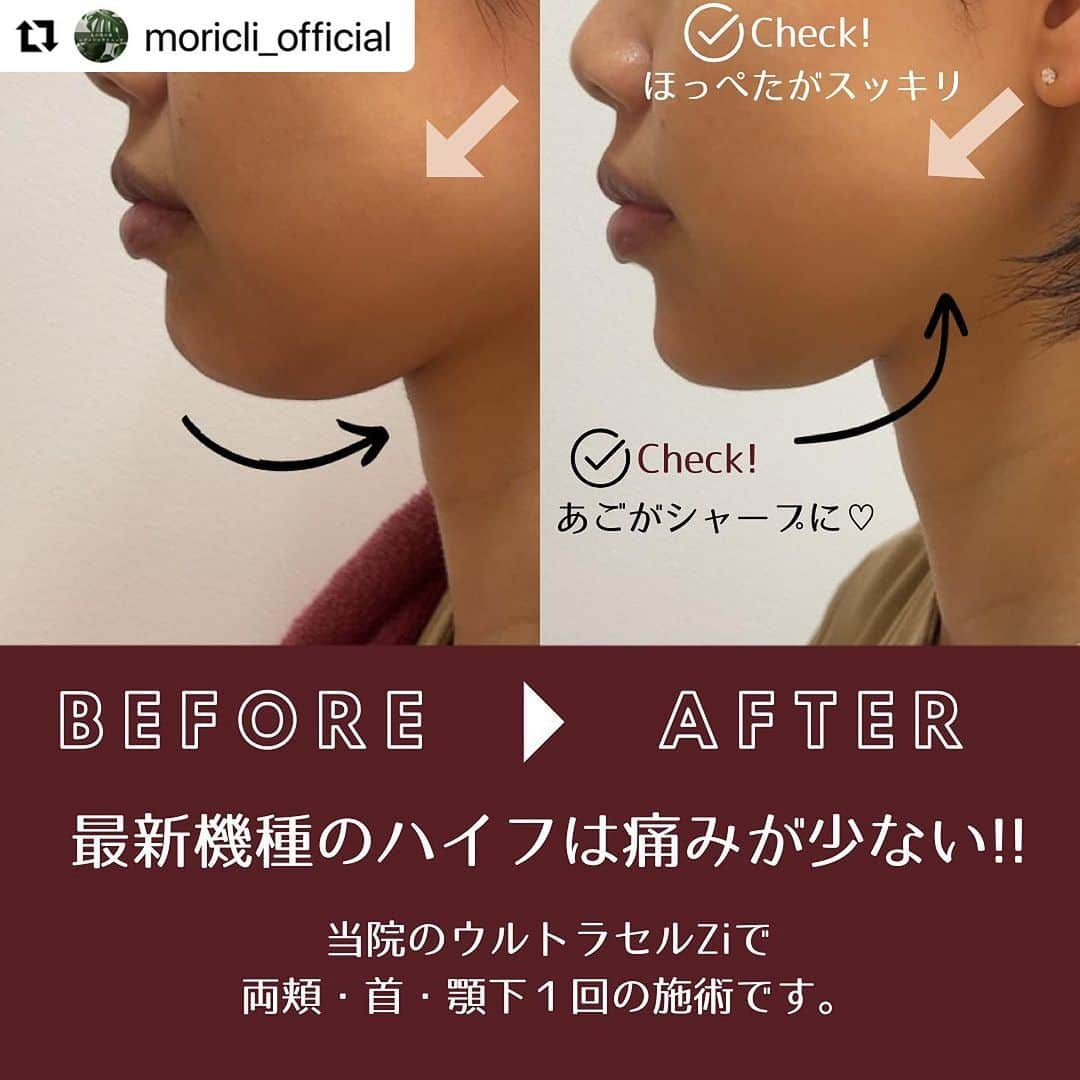 宋美玄さんのインスタグラム写真 - (宋美玄Instagram)「#Repost @moricli_official with @use.repost ・・・ <<はじめての美容皮膚科>> 今日の症例は、あごや頬まわりのたるみ治療の代表格、ハイフ。 「ハイフは痛い！！」という話をきいたことはありますか？  当院のハイフは「ウルトラセルZi（ジー）」という最新機種のハイフです。 従来型のハイフと違い、お痛みが非常に少なくなっています。 過去に施術の経験がある方には 「えー！前のより全然痛くない！」と驚かれています。  写真は1回の施術ですが、 ビフォーアフターを見ていただくと、 ほっぺた周りがすっきりして、 アゴがシャープになっているのがおわかりいただけると思います。  たるみ治療に興味のある方は、一度カウンセリングでご相談ください。  #ハイフ #はじめての美容皮膚科 #丸の内の森レディースクリニック　#美容施術 #美容施術レポ #痛くないハイフ #ウルトラセルzi #あごスッキリ #美容 #産婦人科 #女性の悩み #美容相談」8月28日 16時41分 - mihyonsongkobe