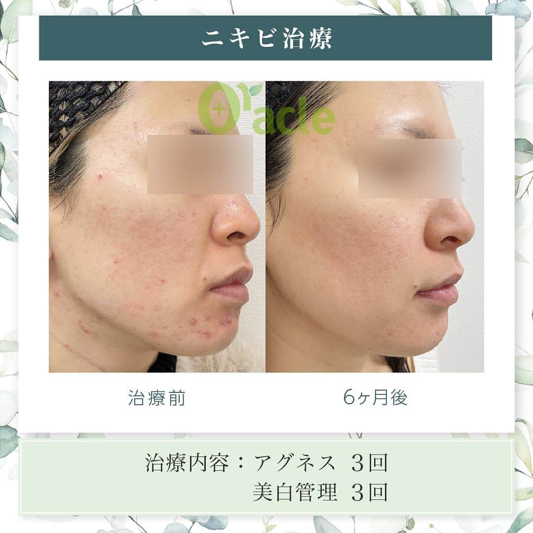 オラクル美容皮膚科東京新宿院さんのインスタグラム写真 - (オラクル美容皮膚科東京新宿院Instagram)「|◤ニキビ治療◢| ☞アグネス3回経過　  《治療内容》 アグネス全顔3回 美白管理3回 ※炎症のニキビが治まって後は、定期的なピーリングで皮脂コントロールをし予防がおすすめです。  ☑️アグネス ニキビの原因となる皮脂腺を直接破壊し、破壊した毛穴からの再発を半永久的に防ぐニキビの根本治療です。 ビリビリしたお痛みがあるので、麻酔をして痛みを軽減させます。 ⁡ 【ダウンタイム】 赤み：2~3日 腫れ：数日～2週間ほど出る方もいる 内出血：1~2週間 洗顔、メイクは翌日以降◎ ⁡ 【料金】 ☞初回部分　19,800円 ☞部分通常　22,000円 ①こめかみ片側 ②鼻（眉間〜鼻） ③顎 ①②③のいづれか1箇所  ☞⁡半顔　44,000円 ①額全体 ②頬片側 ③顎下～首 ①②③のいづれか1箇所  ☞全顔　66,000円 ※別途、麻酔代2,200円  ☑️美白管理 ニキビのお肌は乾燥している方が多く、その乾燥がニキビの原因になっているいることも… 美白管理では、お肌の状態に合わせてビタミンＣ、もしくはトラネキサム酸をお肌に導入していきます。 ⁡ 【料金】 1回　11,000円(税込)  ※薬剤込▶︎トラネキサム酸orビタミンC ☞肌状態でお選びいたします。 ⁡ #アグネス #ニキビ治療 #ニキビ肌 #ニキビ跡 #ニキビケア #ニキビ肌 #ニキビ肌改善 #美肌 #肌質改善 #ニキビ皮膚科 #皮膚科」8月29日 12時20分 - oraclejp