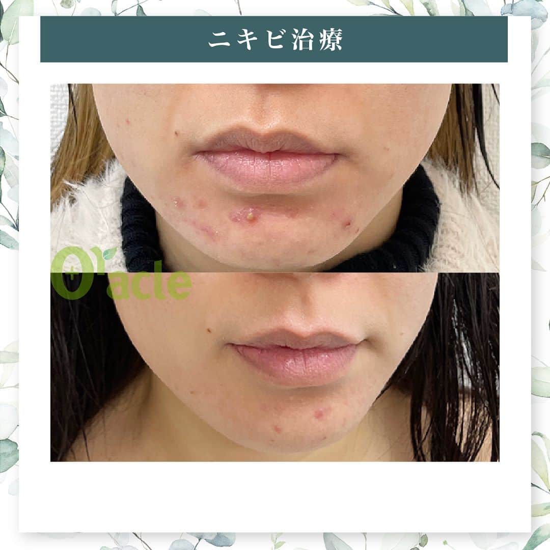 オラクル美容皮膚科東京新宿院さんのインスタグラム写真 - (オラクル美容皮膚科東京新宿院Instagram)「|◤ニキビ治療◢| ☞アグネス3回経過　  《治療内容》 アグネス全顔3回 美白管理3回 ※炎症のニキビが治まって後は、定期的なピーリングで皮脂コントロールをし予防がおすすめです。  ☑️アグネス ニキビの原因となる皮脂腺を直接破壊し、破壊した毛穴からの再発を半永久的に防ぐニキビの根本治療です。 ビリビリしたお痛みがあるので、麻酔をして痛みを軽減させます。 ⁡ 【ダウンタイム】 赤み：2~3日 腫れ：数日～2週間ほど出る方もいる 内出血：1~2週間 洗顔、メイクは翌日以降◎ ⁡ 【料金】 ☞初回部分　19,800円 ☞部分通常　22,000円 ①こめかみ片側 ②鼻（眉間〜鼻） ③顎 ①②③のいづれか1箇所  ☞⁡半顔　44,000円 ①額全体 ②頬片側 ③顎下～首 ①②③のいづれか1箇所  ☞全顔　66,000円 ※別途、麻酔代2,200円  ☑️美白管理 ニキビのお肌は乾燥している方が多く、その乾燥がニキビの原因になっているいることも… 美白管理では、お肌の状態に合わせてビタミンＣ、もしくはトラネキサム酸をお肌に導入していきます。 ⁡ 【料金】 1回　11,000円(税込)  ※薬剤込▶︎トラネキサム酸orビタミンC ☞肌状態でお選びいたします。 ⁡ #アグネス #ニキビ治療 #ニキビ肌 #ニキビ跡 #ニキビケア #ニキビ肌 #ニキビ肌改善 #美肌 #肌質改善 #ニキビ皮膚科 #皮膚科」8月29日 12時20分 - oraclejp