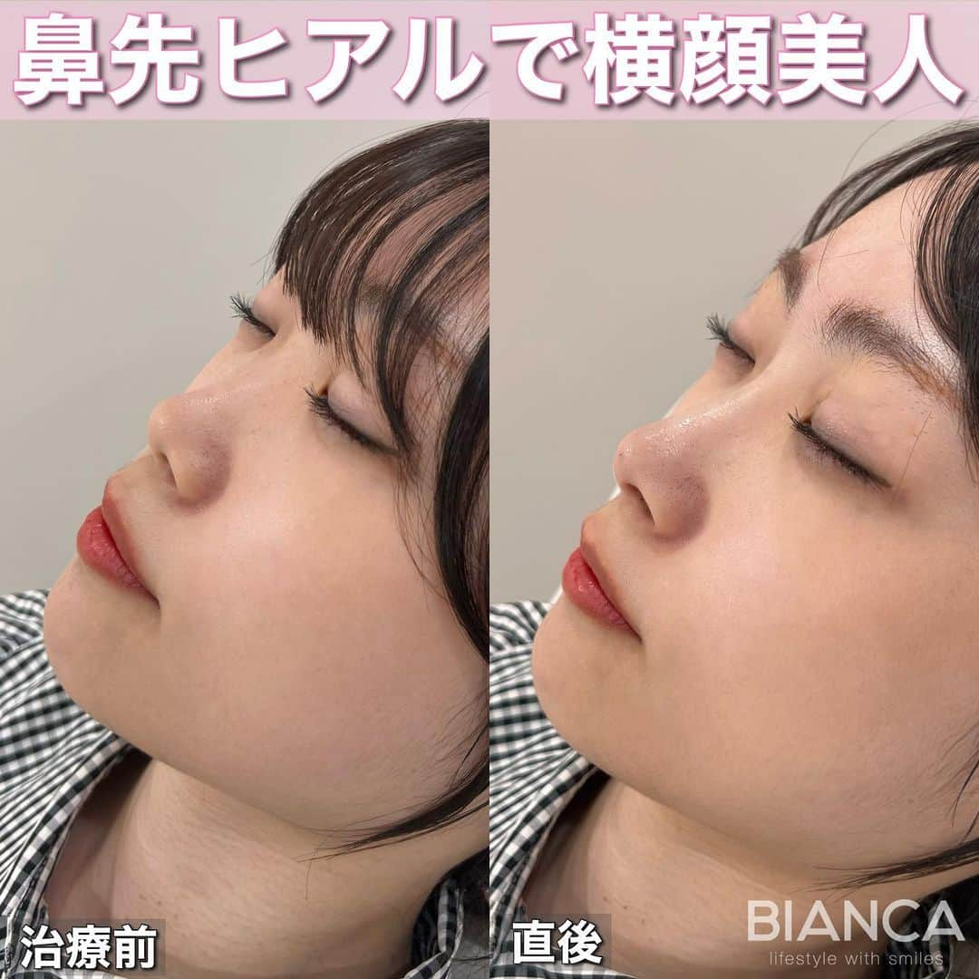 辻沢由有（BIANCA CLNIC 表参道院 院長）のインスタグラム：「#dryuuヒアル　 【ヒアルロン酸でさらに美人へ✨】  治療時間、約10分👏 ヒアルロン酸でお顔を更に洗練🎉  どうなりたいかわからない方も こだわりがたくさんある方も 綺麗になりたい方、お任せください🥰  ✽.｡.:*・ﾟ ✽.｡.:*・ﾟ ✽.｡.:*・ﾟ ✽.｡.:*・ﾟ ✽.｡.:*・ﾟ  ✔︎鼻先〜鼻筋ヒアルロン酸 レスチレンリフト 1ml  107,800円＋税 別途施術料　22,000円＋税  ⏳治療時間: 10分 🗓持続期間: 1〜2年 😷腫れ・内出血: 数日程度 ⚠️リスク: 感染・血流障害・凹凸など  ✽.｡.:*・ﾟ ✽.｡.:*・ﾟ ✽.｡.:*・ﾟ ✽.｡.:*・ﾟ ✽.｡.:*・ﾟ  📝ご予約はwebが便利です✨ プロフィール欄のリンクからご予約ください。 ※医師指名可能（“大久保医師指名”をクリック） ※診察料はかかりません🙅‍♀️ ※表参道院勤務が9割となっています。  📍BIANCA CLINIC ※お電話頂くと自動音声通話に繋がります。 ✔︎表参道院 ☎️05018071593 東京都港区南青山5-11-10  南青山511ビル 2F ✔︎銀座院 ☎️05031964834 東京都中央区銀座1-8-19 キラリトギンザ12F  •診療時間 10:00〜19:00 •年中無休（年末年始を除く）   ✽.｡.:*・ﾟ ✽.｡.:*・ﾟ ✽.｡.:*・ﾟ ✽.｡.:*・ﾟ ✽.｡.:*・ﾟ  #鼻ヒアルロン酸 #鼻整形 #鼻先ヒアルロン酸 #eライン #横顔美人 #ヒアルロン酸」