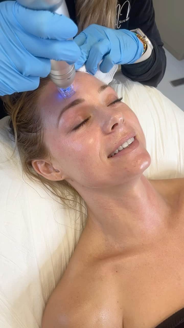 Nikki Leighのインスタグラム：「Stunning actress and model @missnikkileigh shares her experience with one of our favorite treatments: SCARLET! 🤩  After getting so many compliments about her décolleté and loving her beautifully defined jawline, Nikki was eager to come back and see @nursenualla for her second treatment! We can’t wait to share her results as she progresses with her series of 3 SCARLET sessions! Stay tuned! 😍  > Microneedling with Radio Frequency > Minimal downtime > Helps to reduce the appearance of fine lines > Boosts collagen and elastin production > Helps to tighten and firm the skin > Can improve the appearance of scars & stretch marks  Call our office to book in your SCARLET treatment! 3-6 Sessions are recommended, depending on your individual skin goals and concerns. Don’t forget to ask about our packages available! # (310)273-3344」