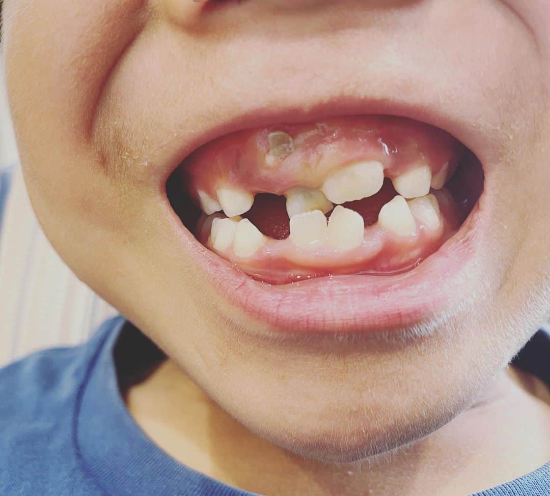 根本美緒さんのインスタグラム写真 - (根本美緒Instagram)「息子のこの歯茎から飛び出た歯🦷ヤバイのでは。。と歯医者さんへ。 なんか昔自転車で転んだからな~と思ってたけれど、衝撃の…なんと、乳歯の下に親知らずがあり←謎の❗️その脇に大人の歯が出られずうごめいている…との事。 なんだかよくわからないけど黒くなった乳歯と大きな歯の2本抜いて縫ってとおおがかりな事になりました💦歯医者さん行ってよかったな😅 一方今日は自分も体調悪いな…夜仕事だからそれまでに回復をはかります！ 天気はお休みで。。 夕方台風と暑さ情報のYouTube出します😊 #歯並び 悪いに止まらず、色々変だったw#7歳」8月31日 12時16分 - nemotomio.official