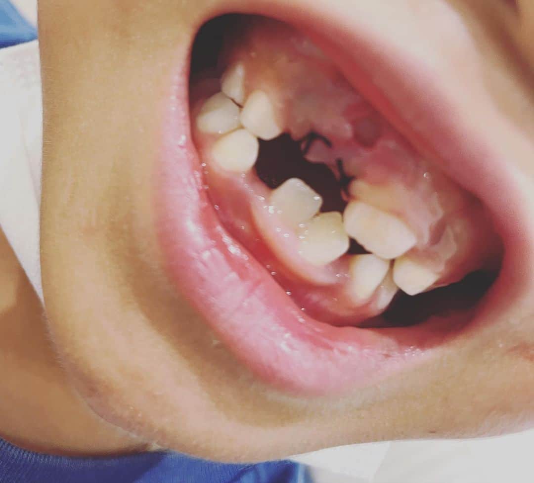 根本美緒さんのインスタグラム写真 - (根本美緒Instagram)「息子のこの歯茎から飛び出た歯🦷ヤバイのでは。。と歯医者さんへ。 なんか昔自転車で転んだからな~と思ってたけれど、衝撃の…なんと、乳歯の下に親知らずがあり←謎の❗️その脇に大人の歯が出られずうごめいている…との事。 なんだかよくわからないけど黒くなった乳歯と大きな歯の2本抜いて縫ってとおおがかりな事になりました💦歯医者さん行ってよかったな😅 一方今日は自分も体調悪いな…夜仕事だからそれまでに回復をはかります！ 天気はお休みで。。 夕方台風と暑さ情報のYouTube出します😊 #歯並び 悪いに止まらず、色々変だったw#7歳」8月31日 12時16分 - nemotomio.official